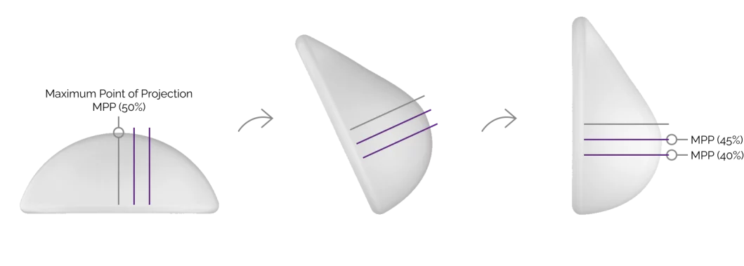 breast-motiva-maximum-point-projection-mo