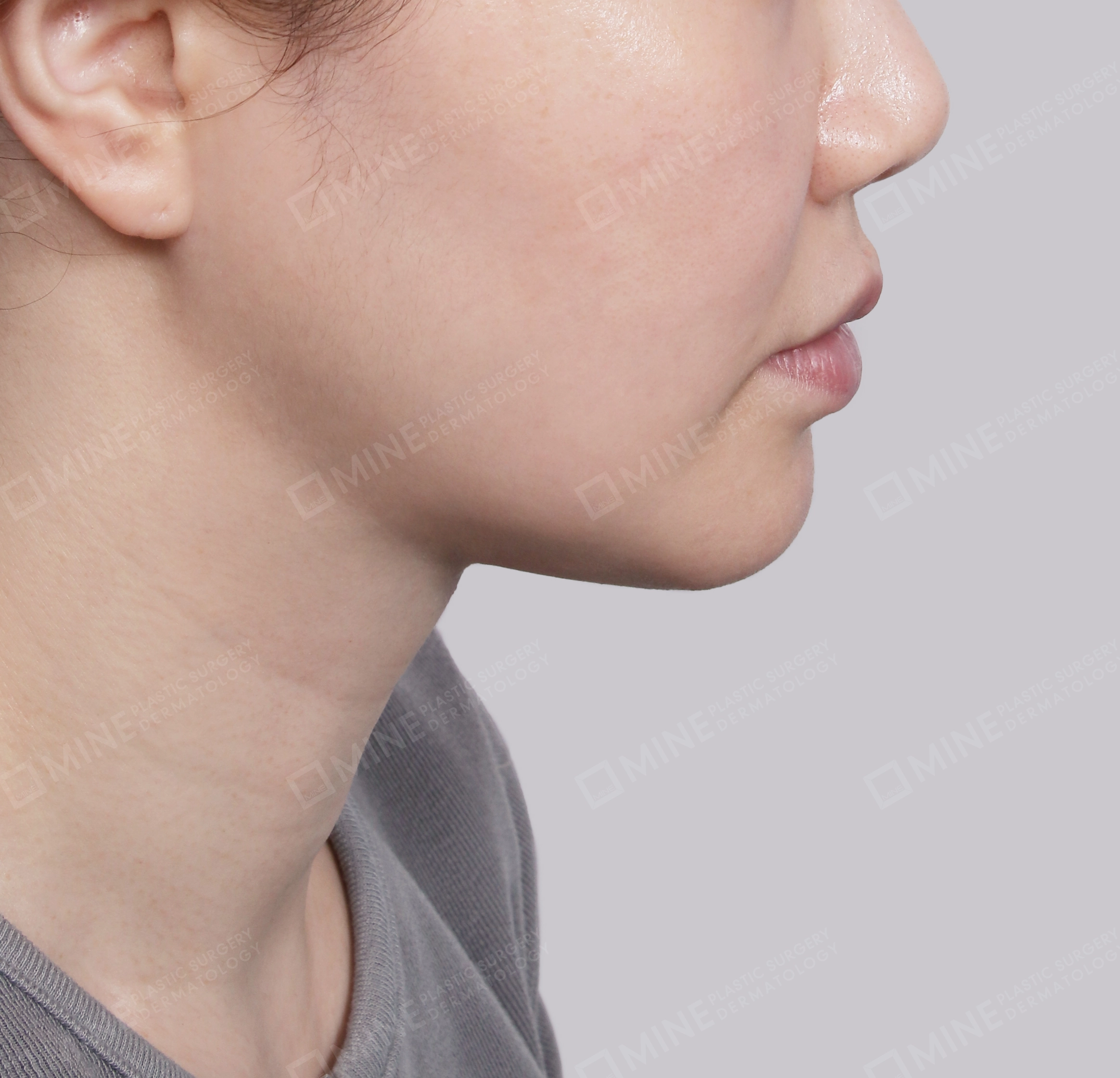 二重顎-側面-術後