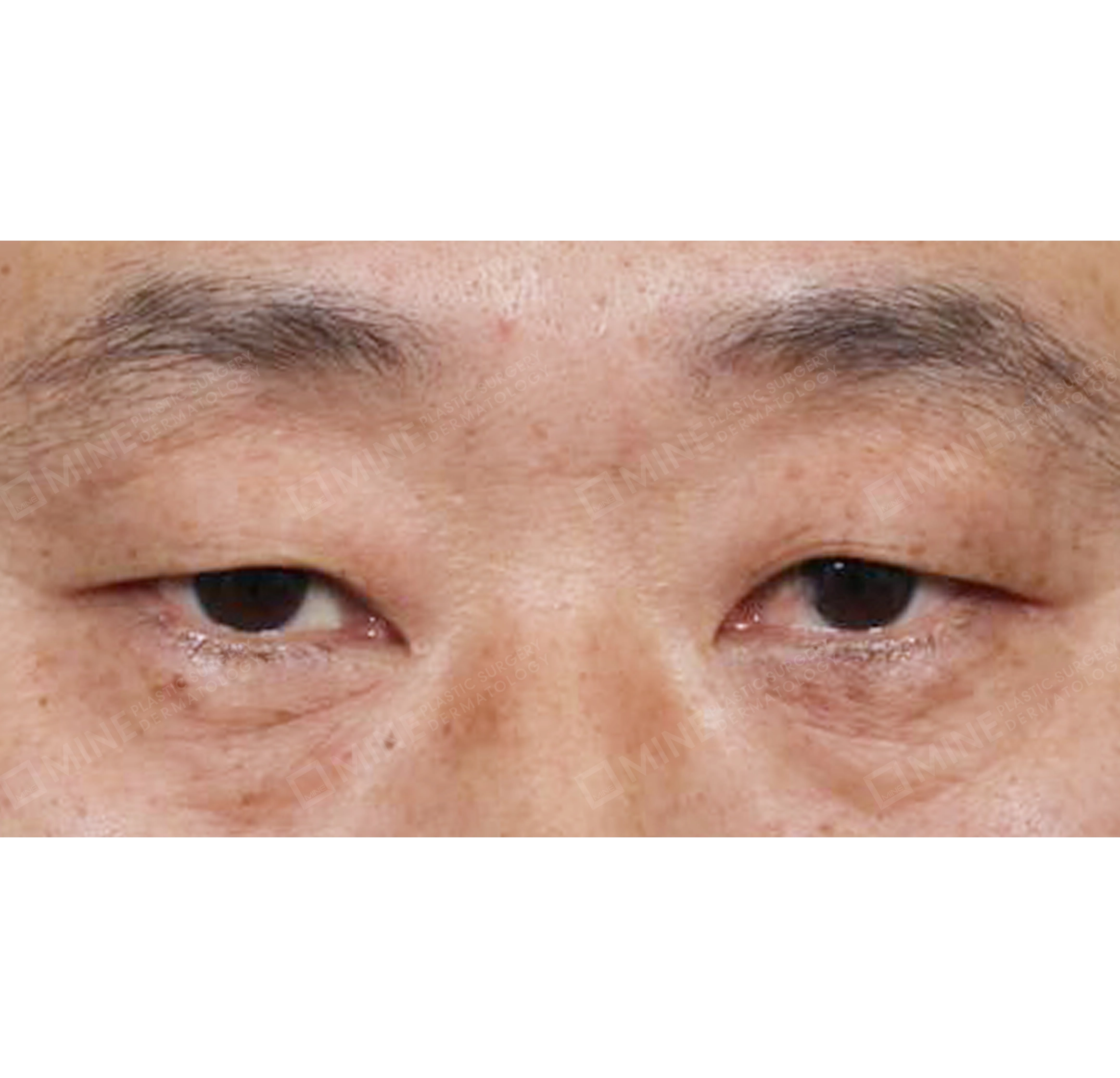 上眼瞼-正面-術前
