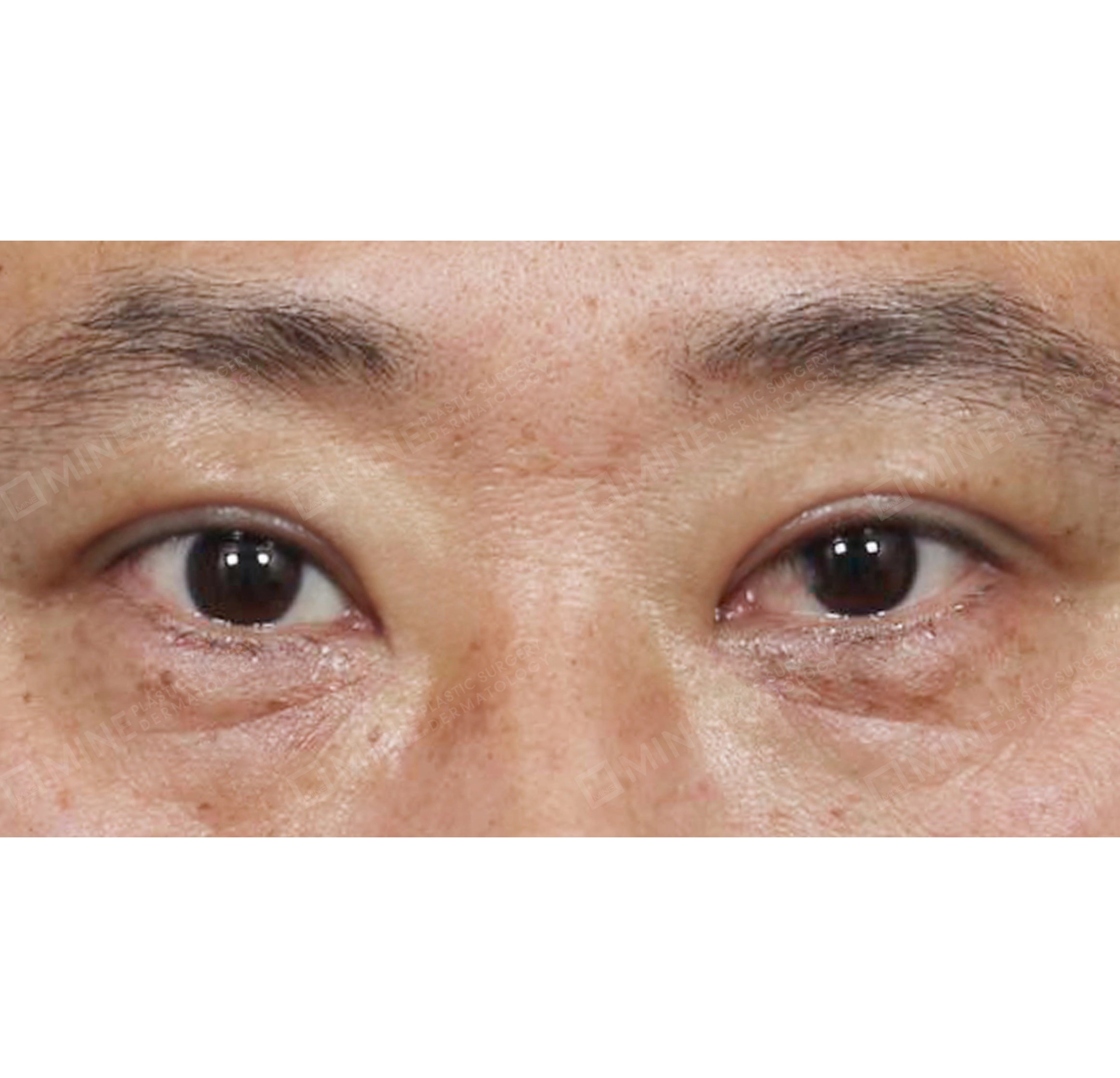 上眼瞼-正面-術後