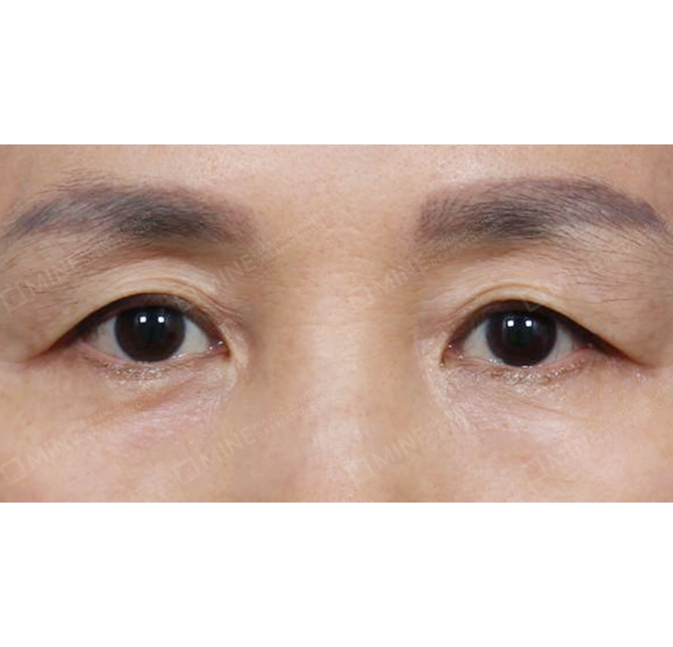 上眼瞼＋下眼瞼＋眉下切開術-正面-術前