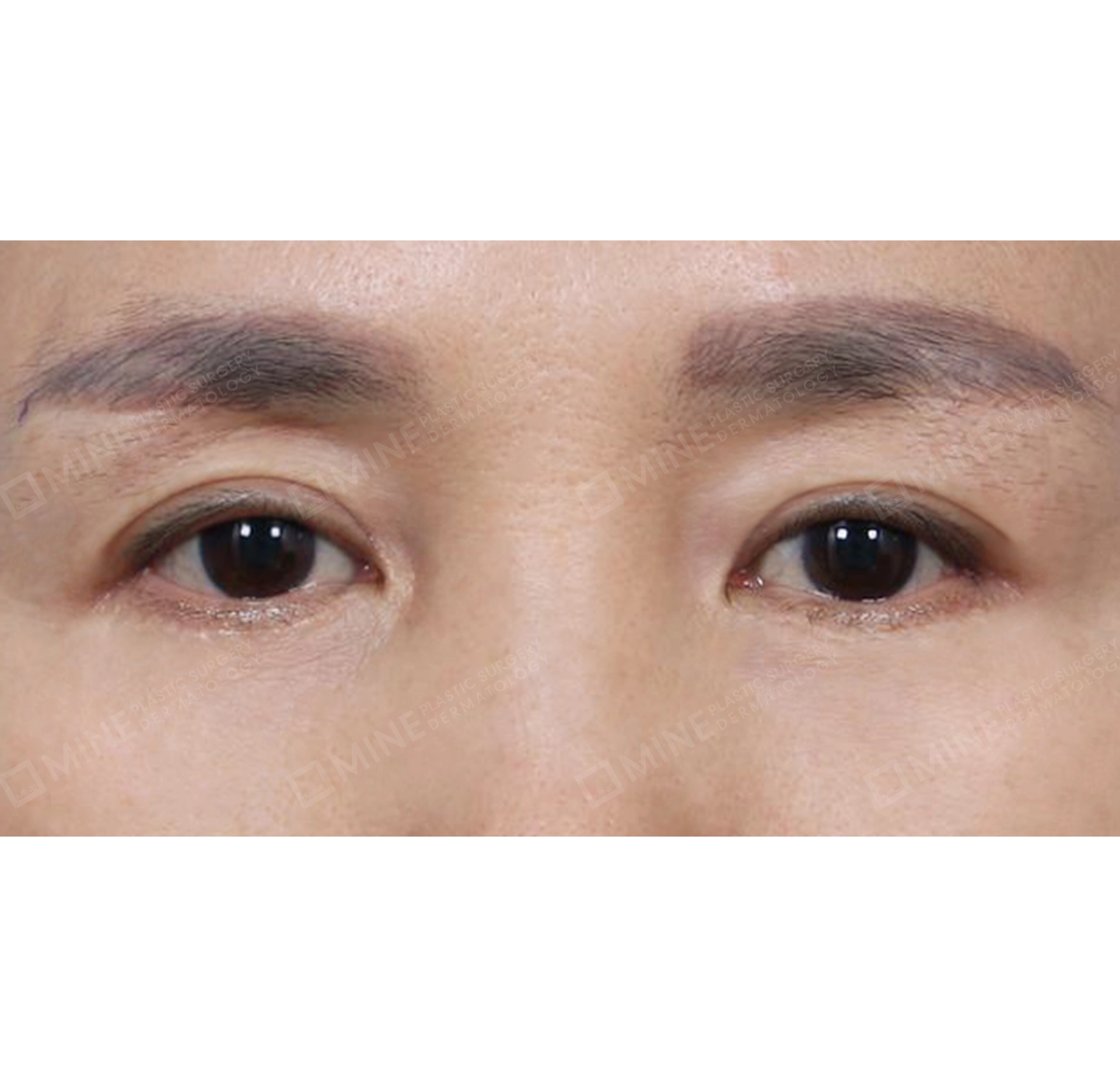 上眼瞼＋下眼瞼＋眉下切開術-正面-術後