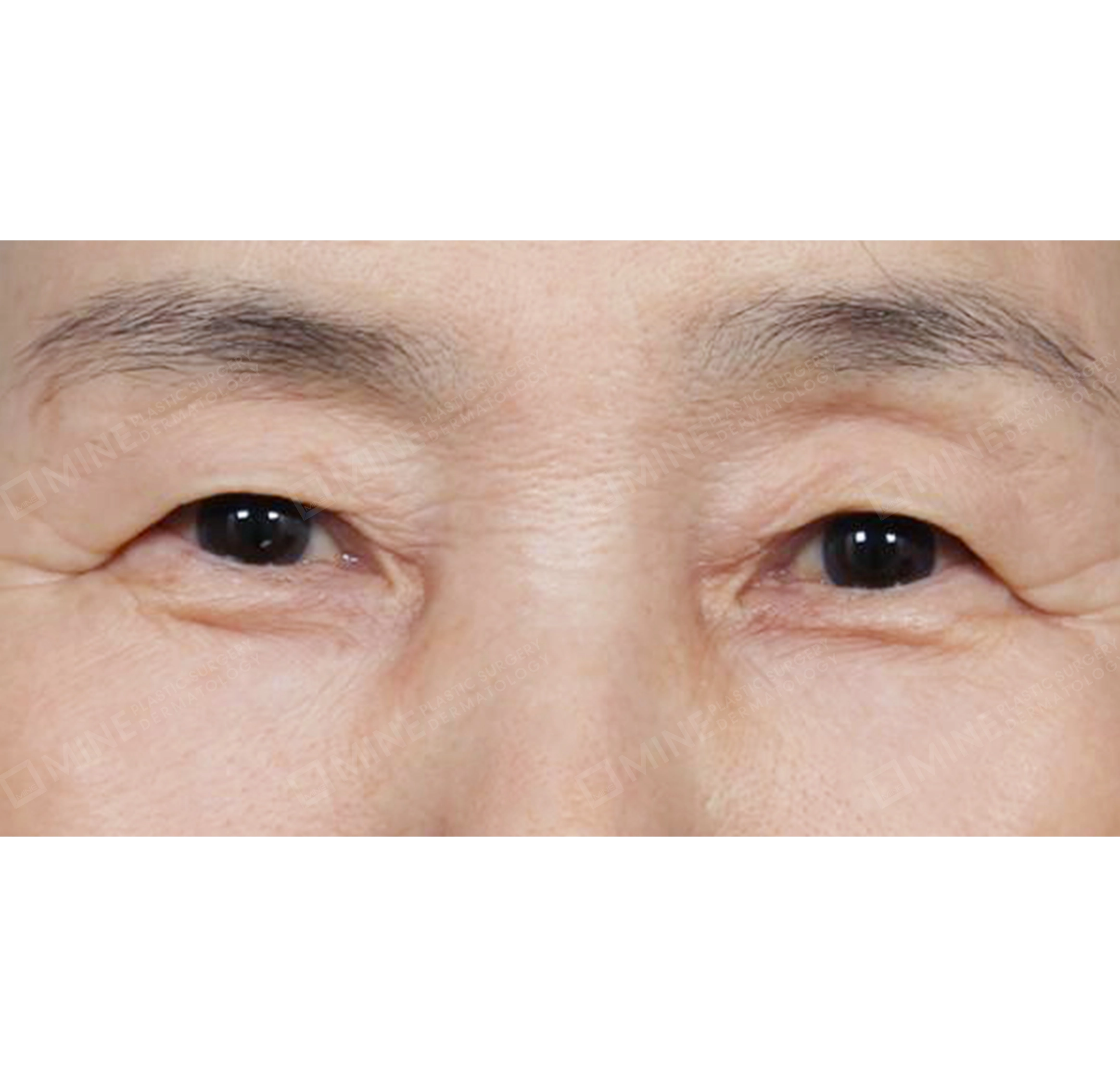 上眼瞼＋下眼瞼＋上瞼脂肪再配置-正面-術前