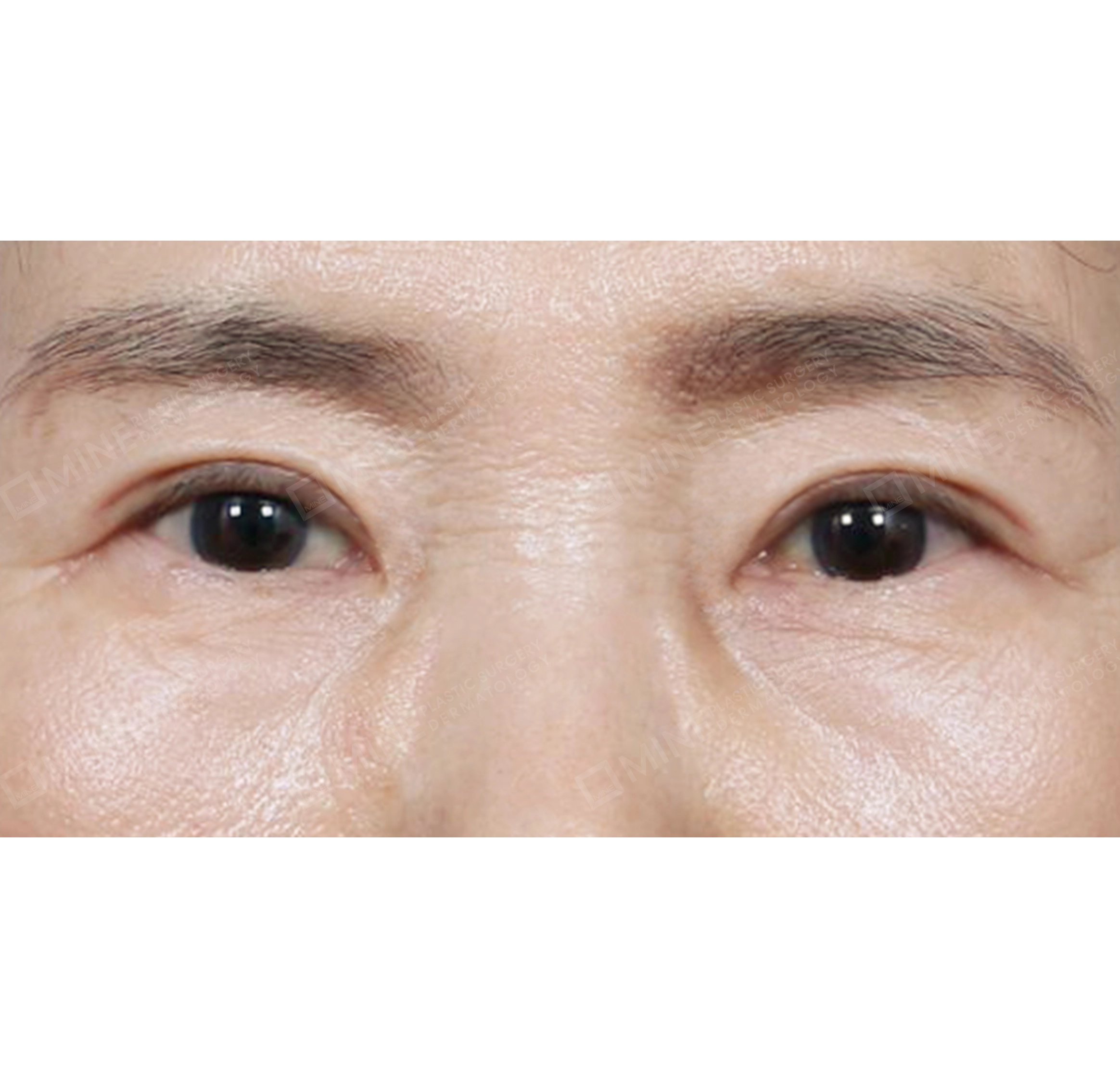 上眼瞼＋下眼瞼＋上瞼脂肪再配置-正面-術後
