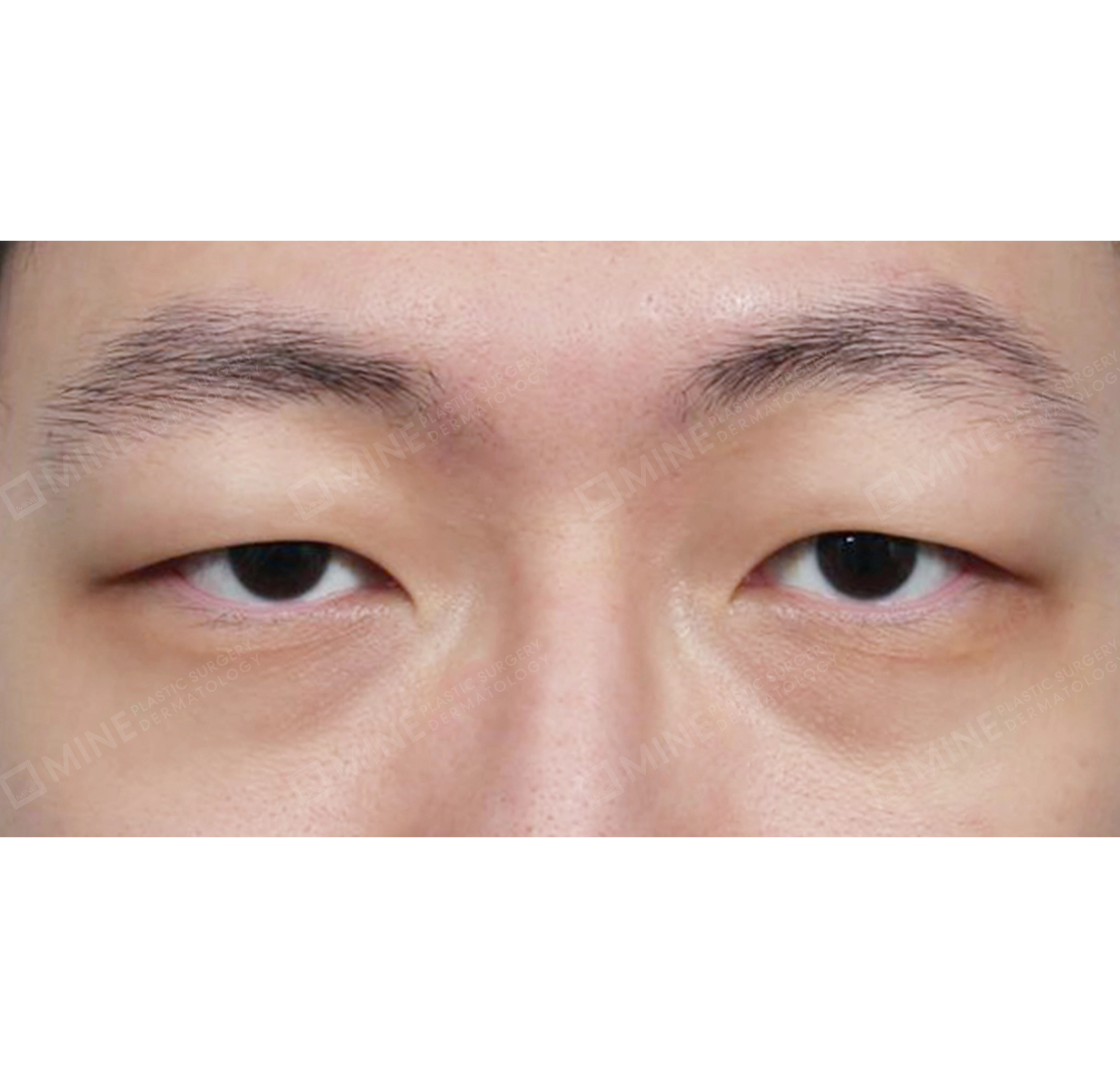切開目つき矯正-正面-術前