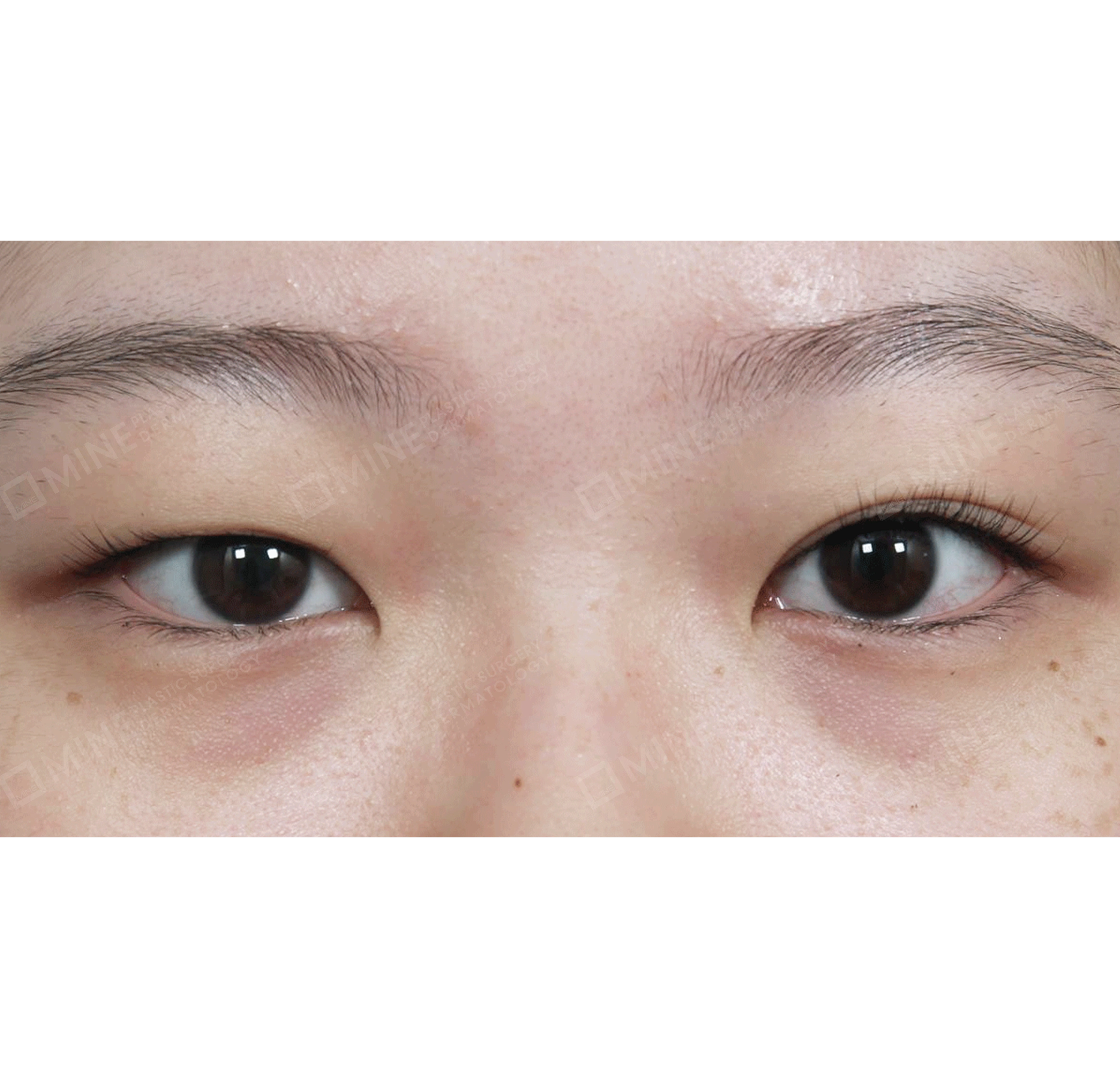 目再手術＋埋没目つき矯正-正面-術前