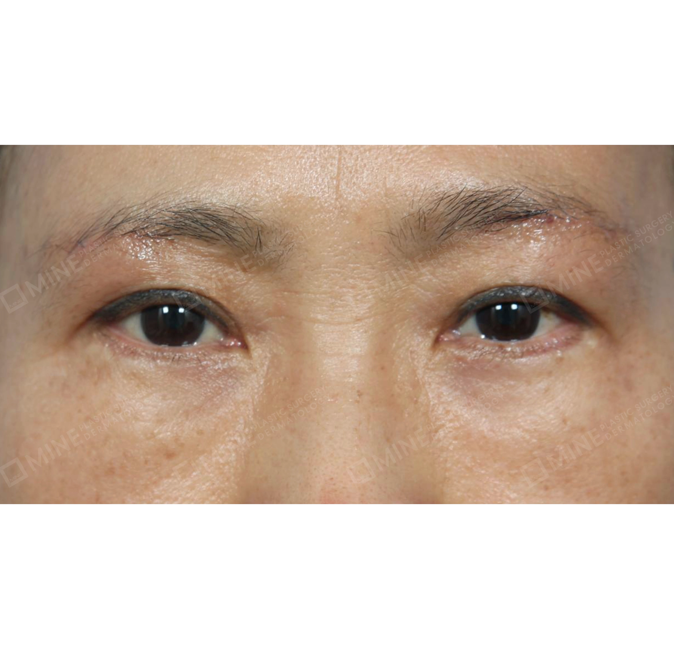 眉下切開術＋切開目つき矯正-正面-術後