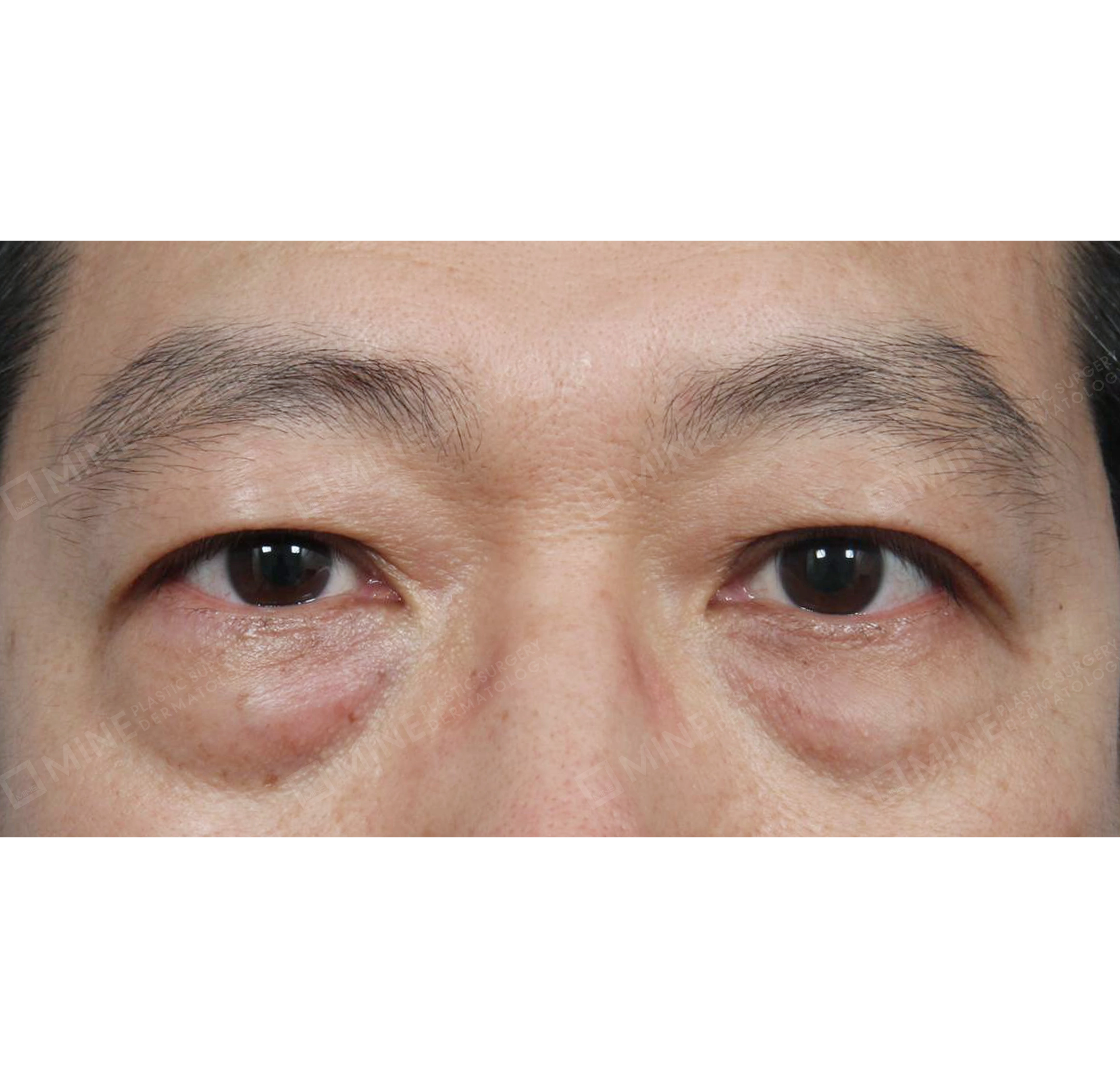 目の下脂肪再配置-正面-術前