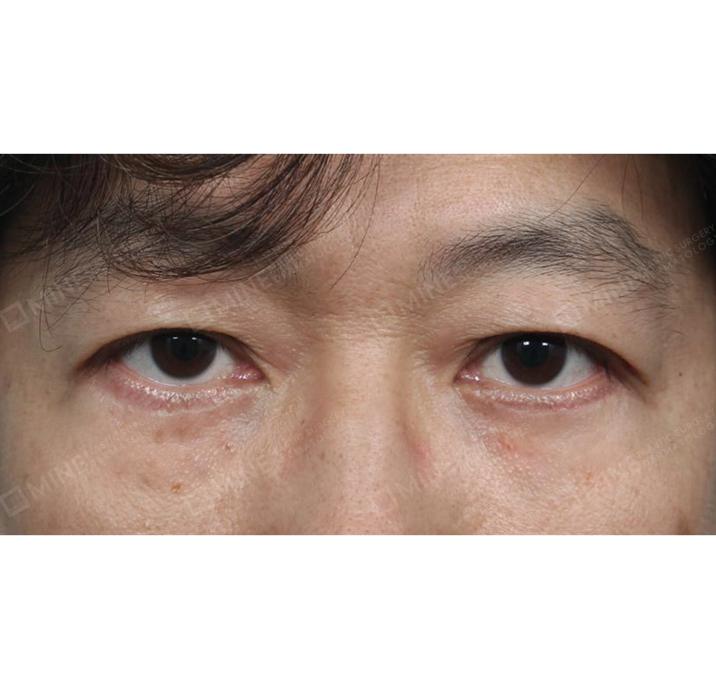 目の下脂肪再配置-正面-術後