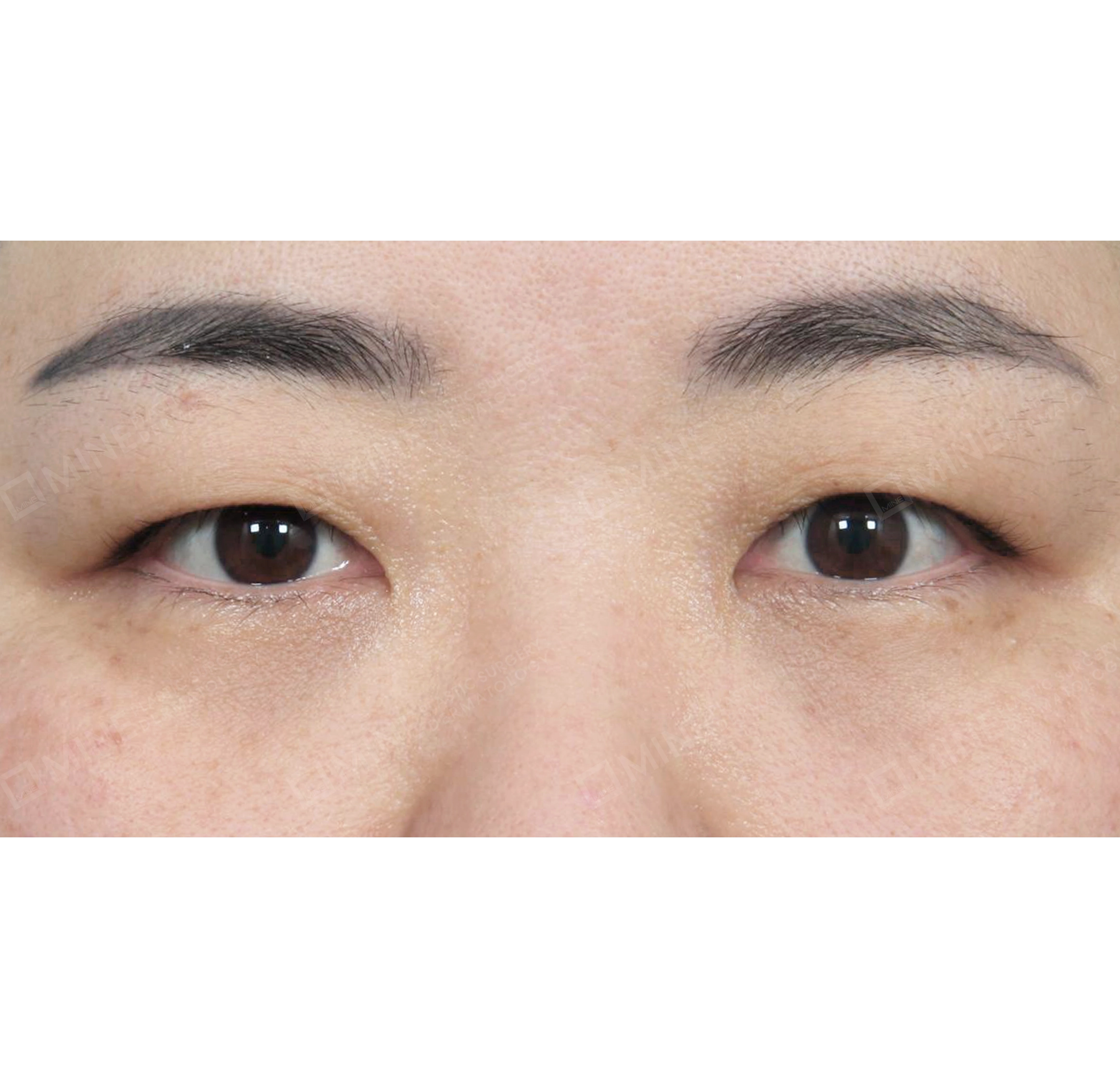 切開目つき矯正-正面-術前