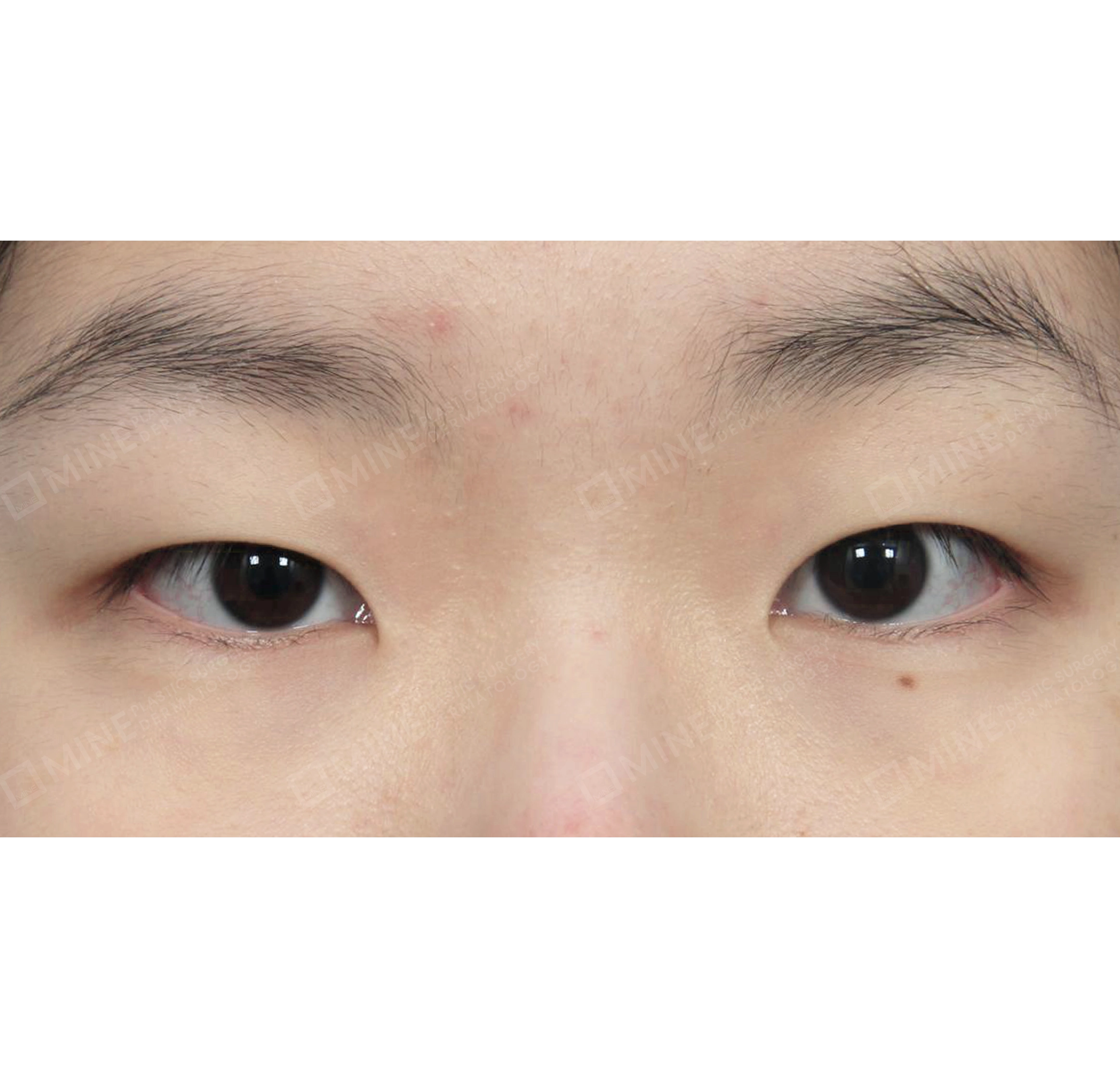 目つき矯正-正面-術前