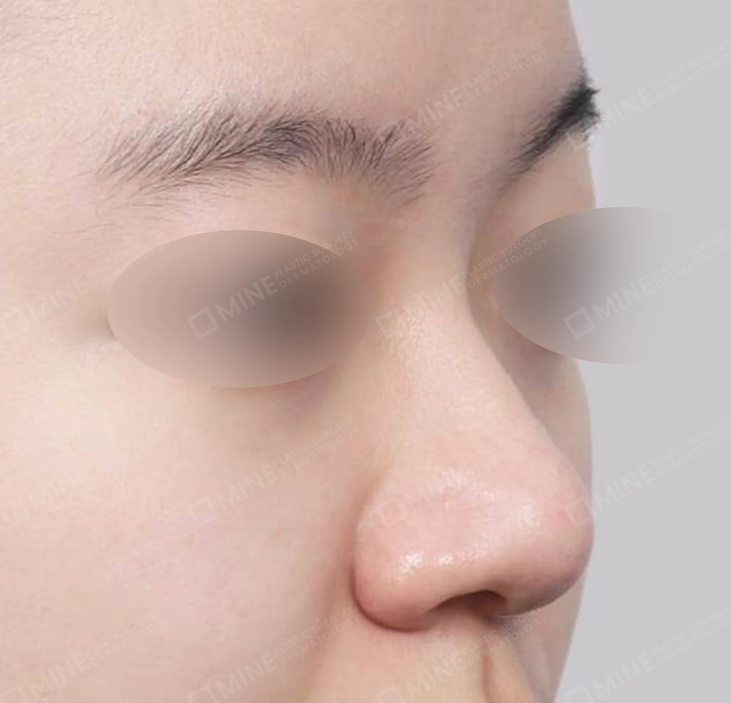 わし鼻 + 骨切り幅寄せ + 小鼻縮小 + 鼻筋-45度-術前