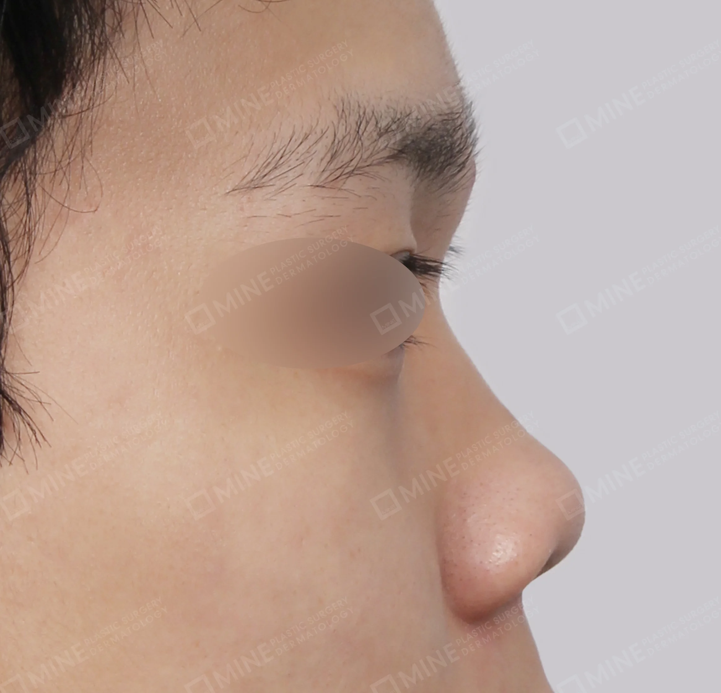 わし鼻 + 鼻筋 + 鼻中隔延長 + 鼻尖縮小-側面-術前