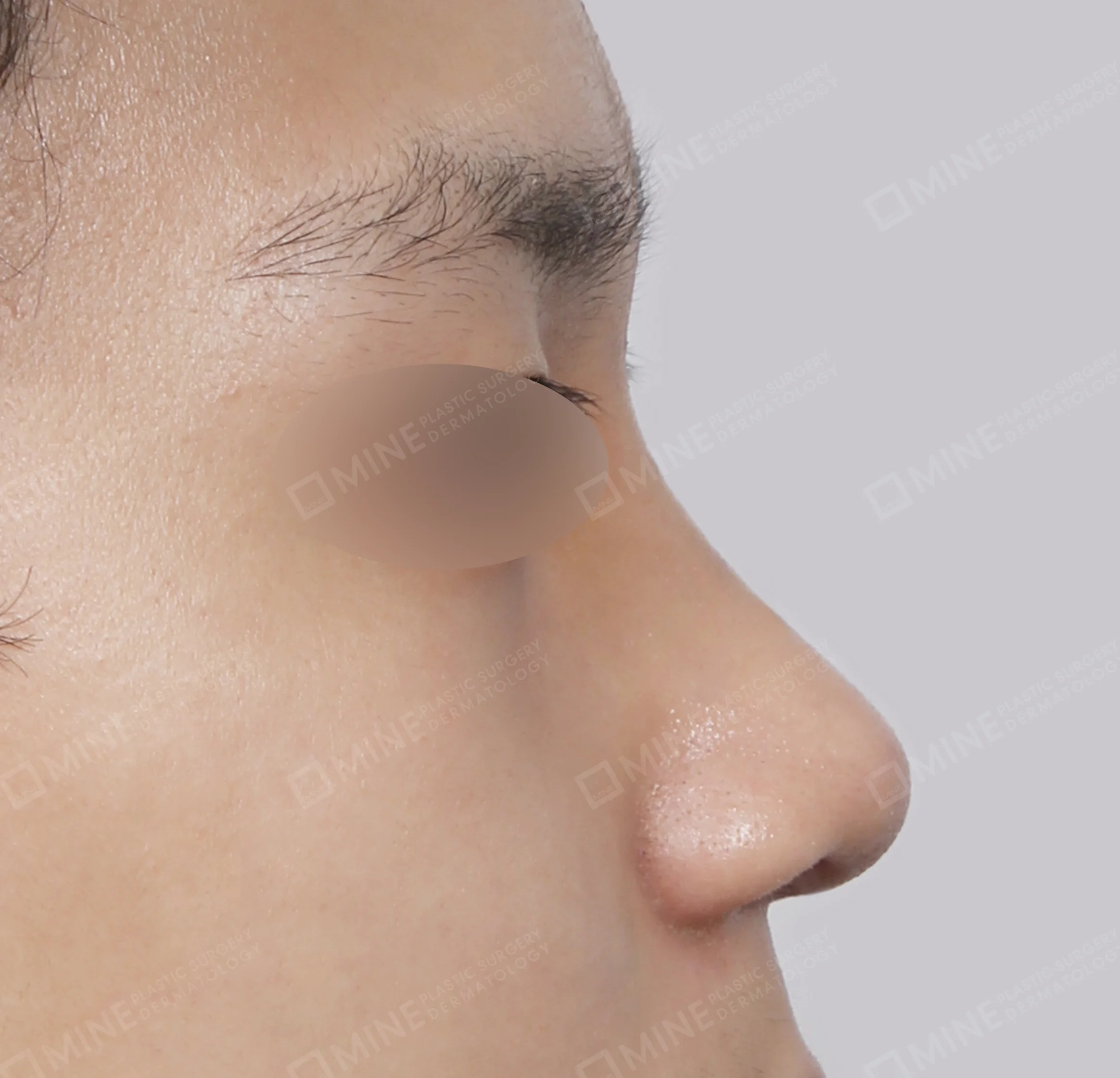 わし鼻 + 鼻筋 + 鼻中隔延長 + 鼻尖縮小-側面-術後