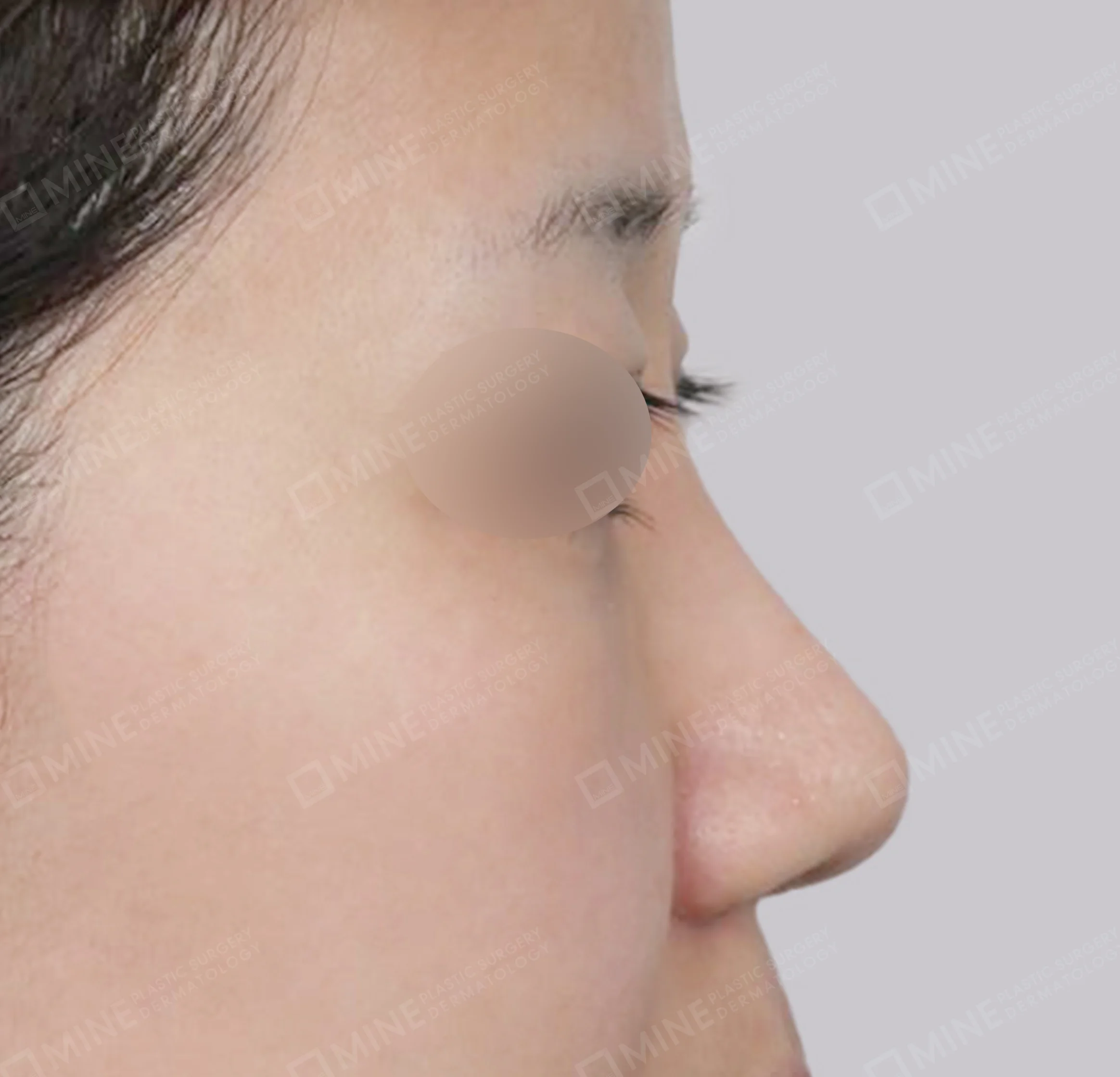 鼻筋 + 鼻尖縮小 + 小鼻縮小 + 鼻中隔延長-側面-術後
