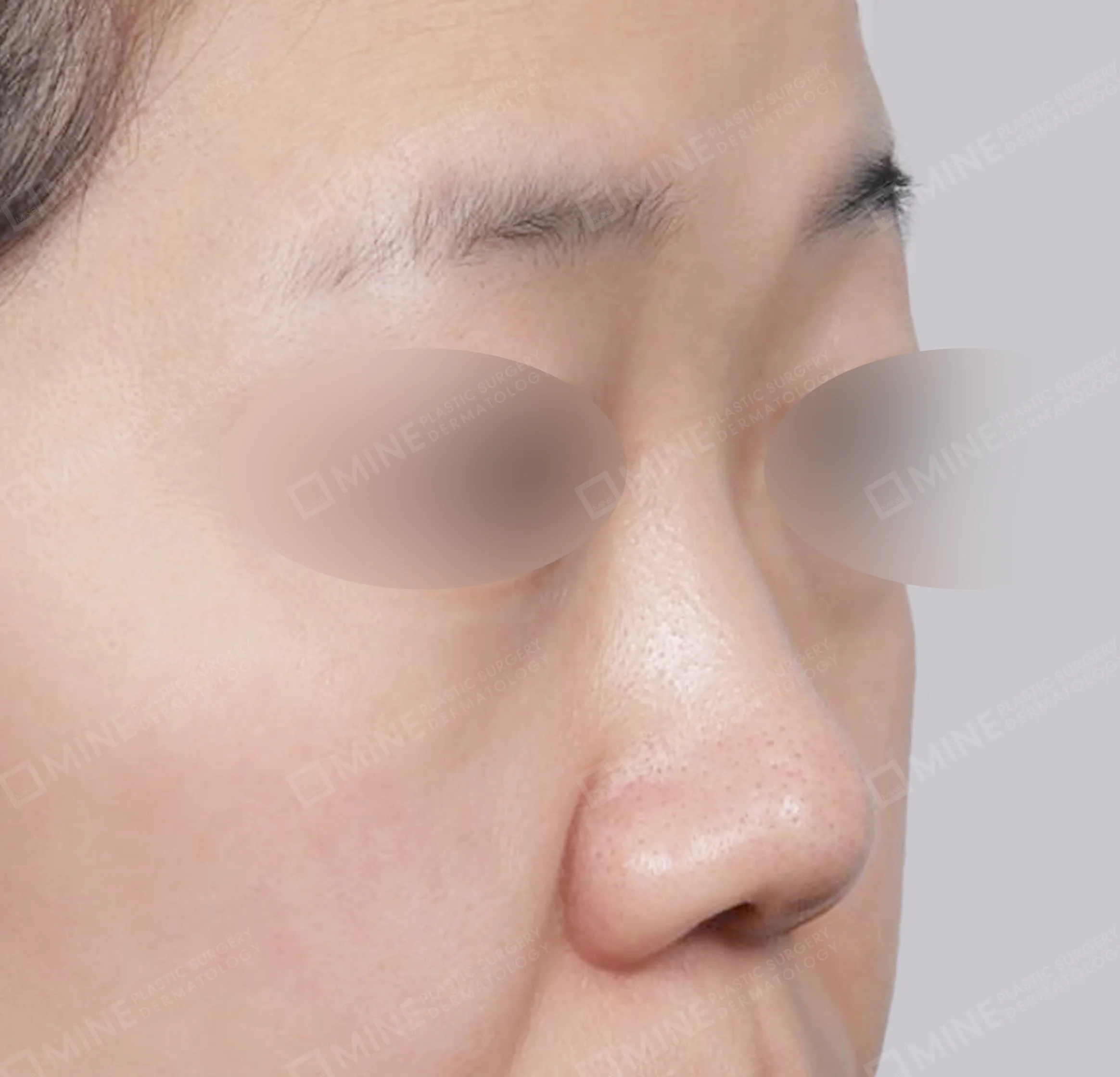 鼻筋 + 鼻尖縮小 + 小鼻縮小 + 鼻中隔延長-45度-術前
