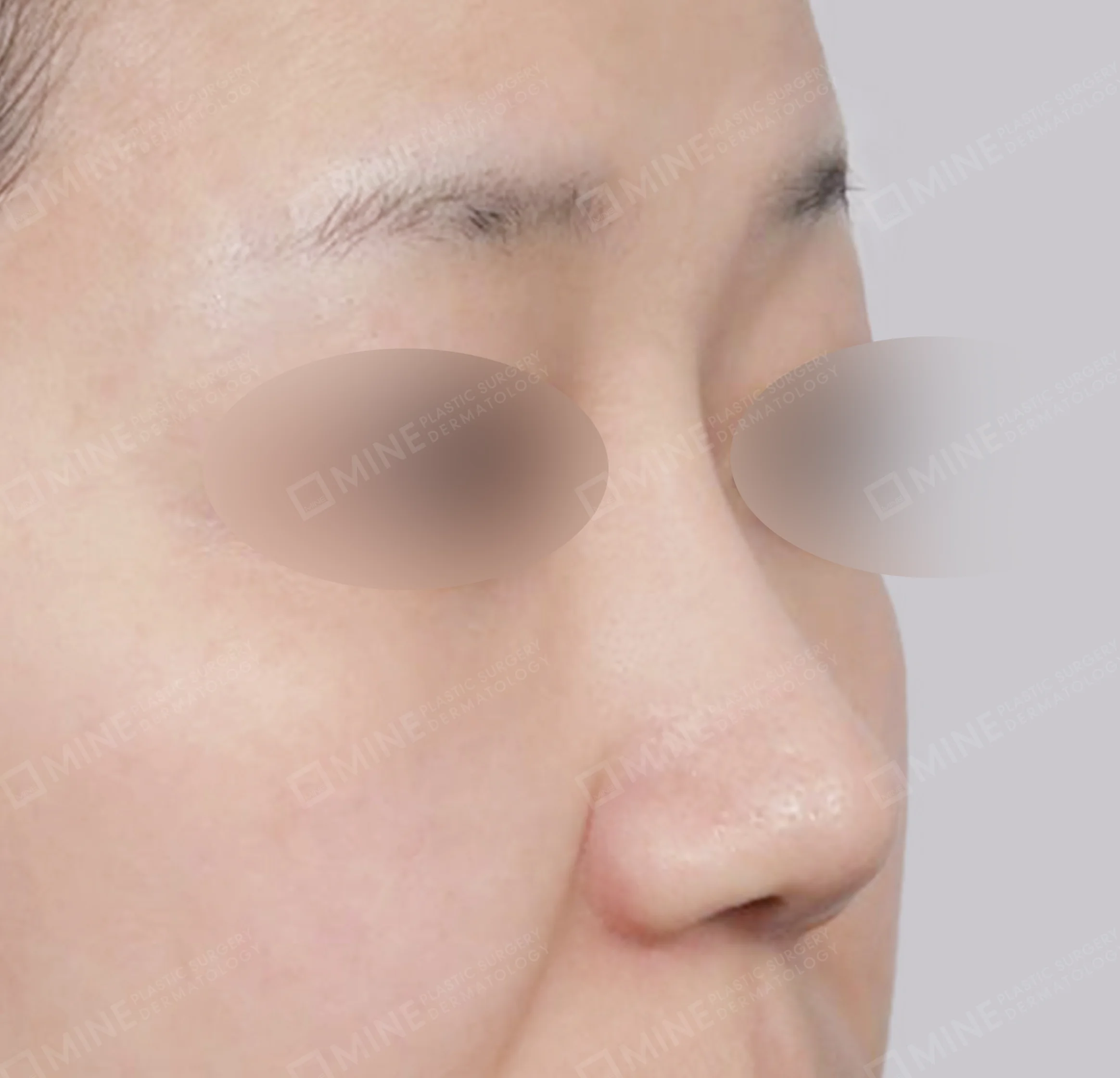 鼻筋 + 鼻尖縮小 + 小鼻縮小 + 鼻中隔延長-45度-術後