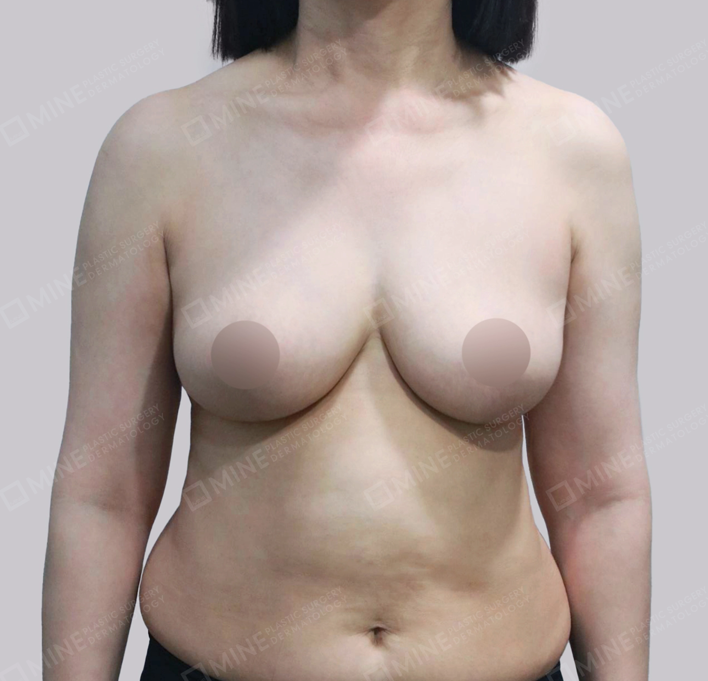 乳房縮小-正面-術後