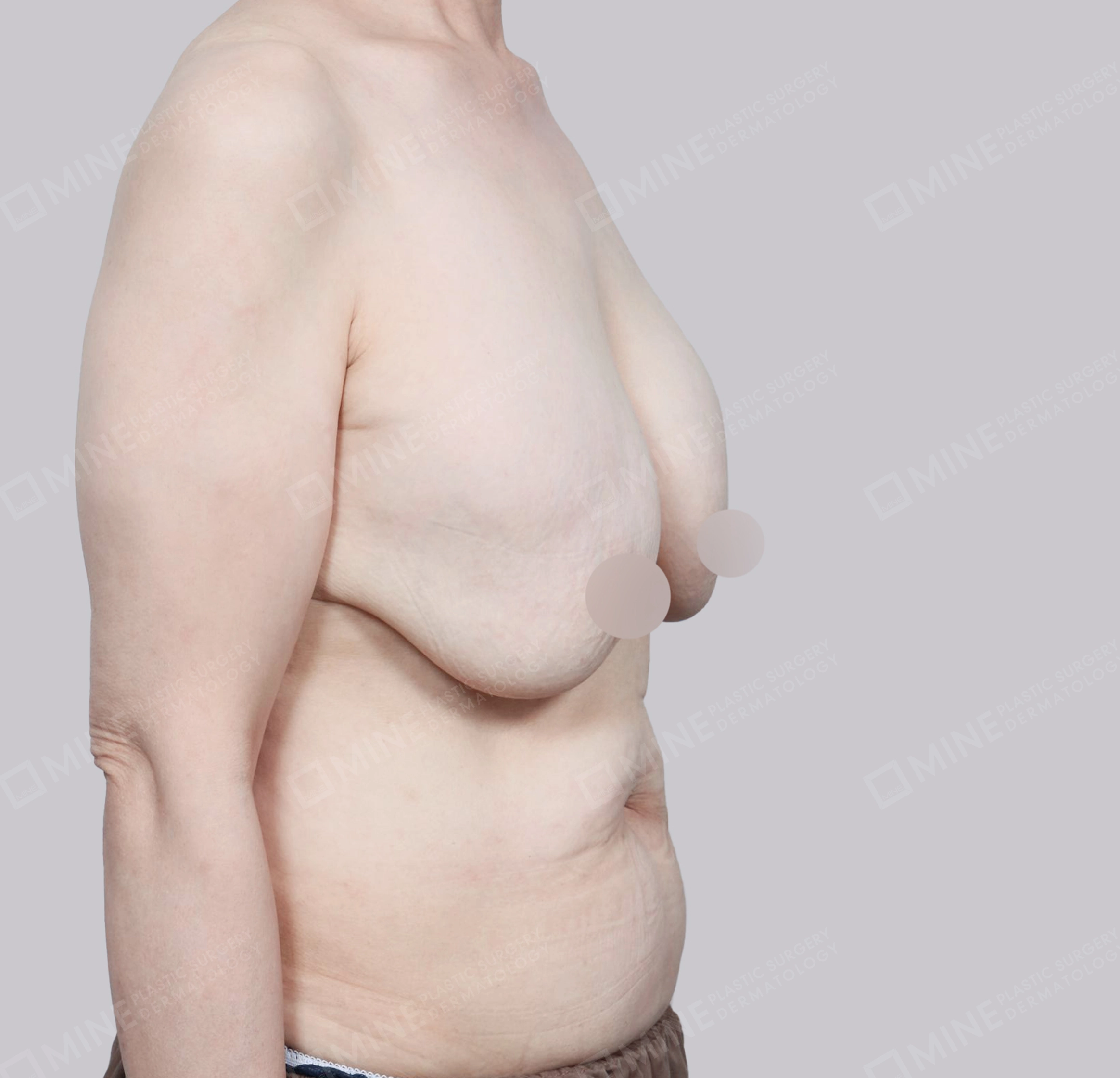 乳房縮小-側面-術前