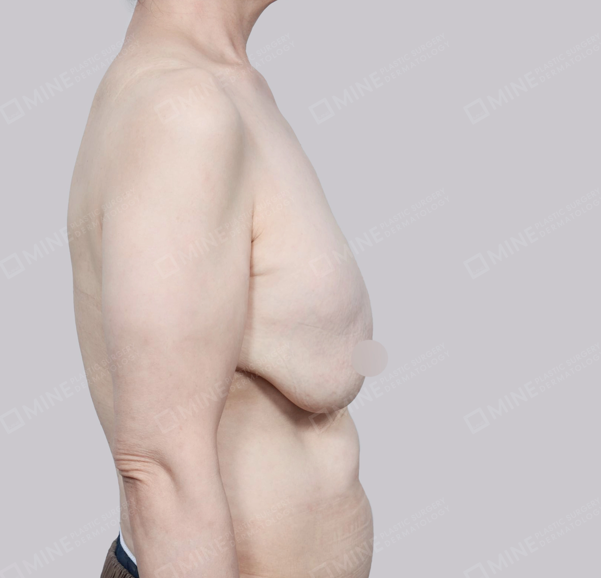 乳房縮小-45度-術前