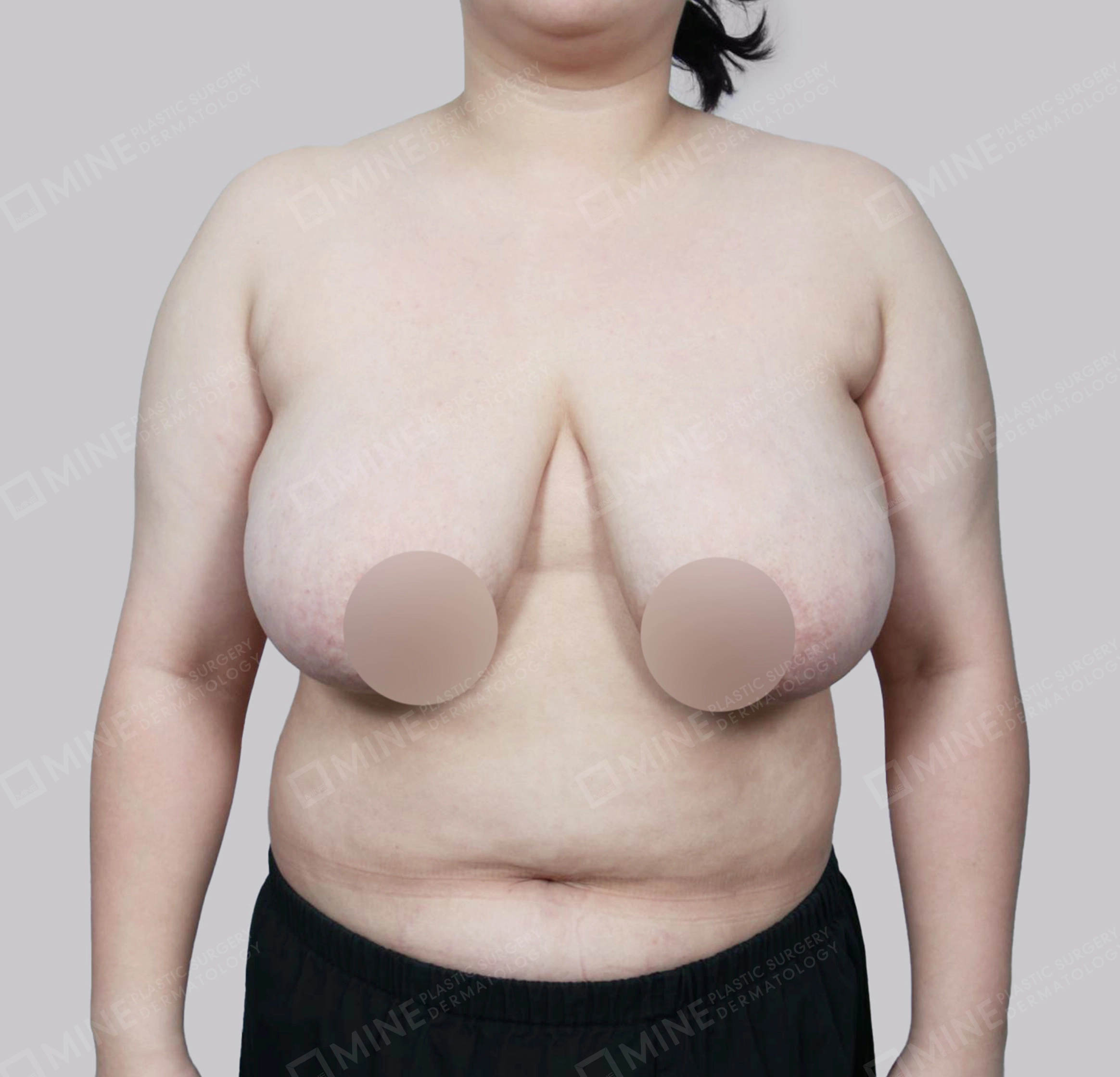 乳房縮小-正面-術前