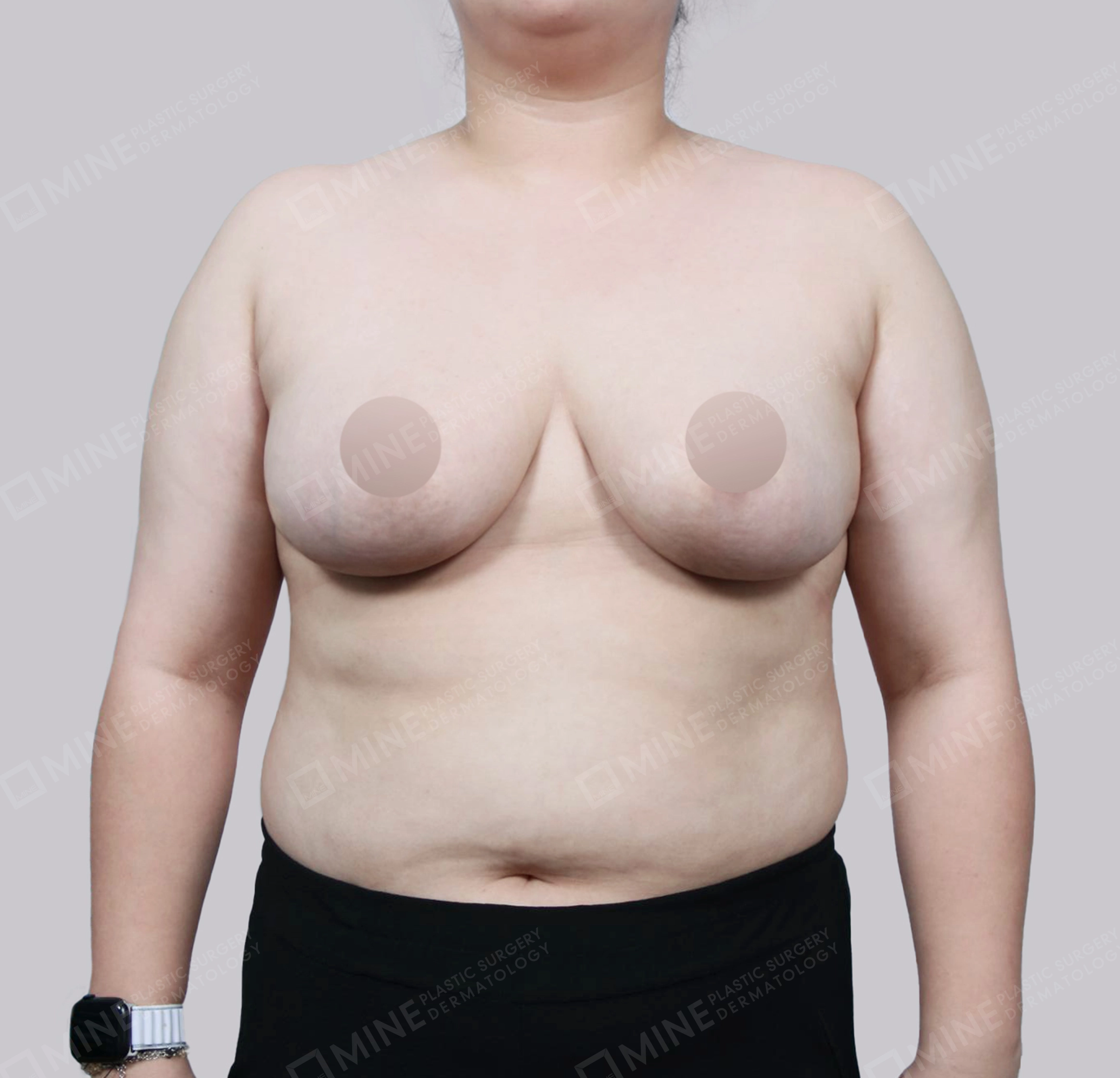 乳房縮小-正面-術後