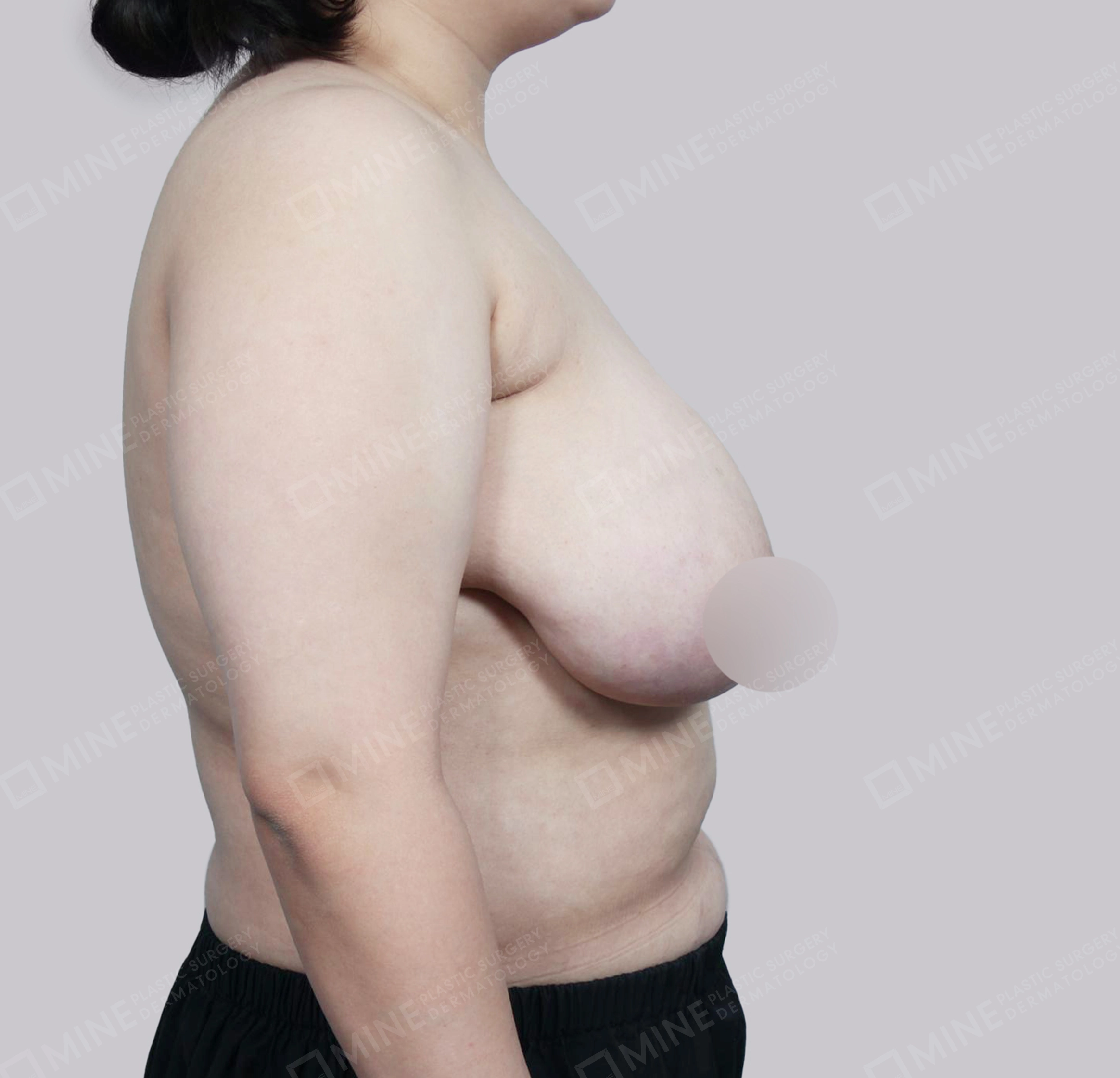 乳房縮小-側面-術前