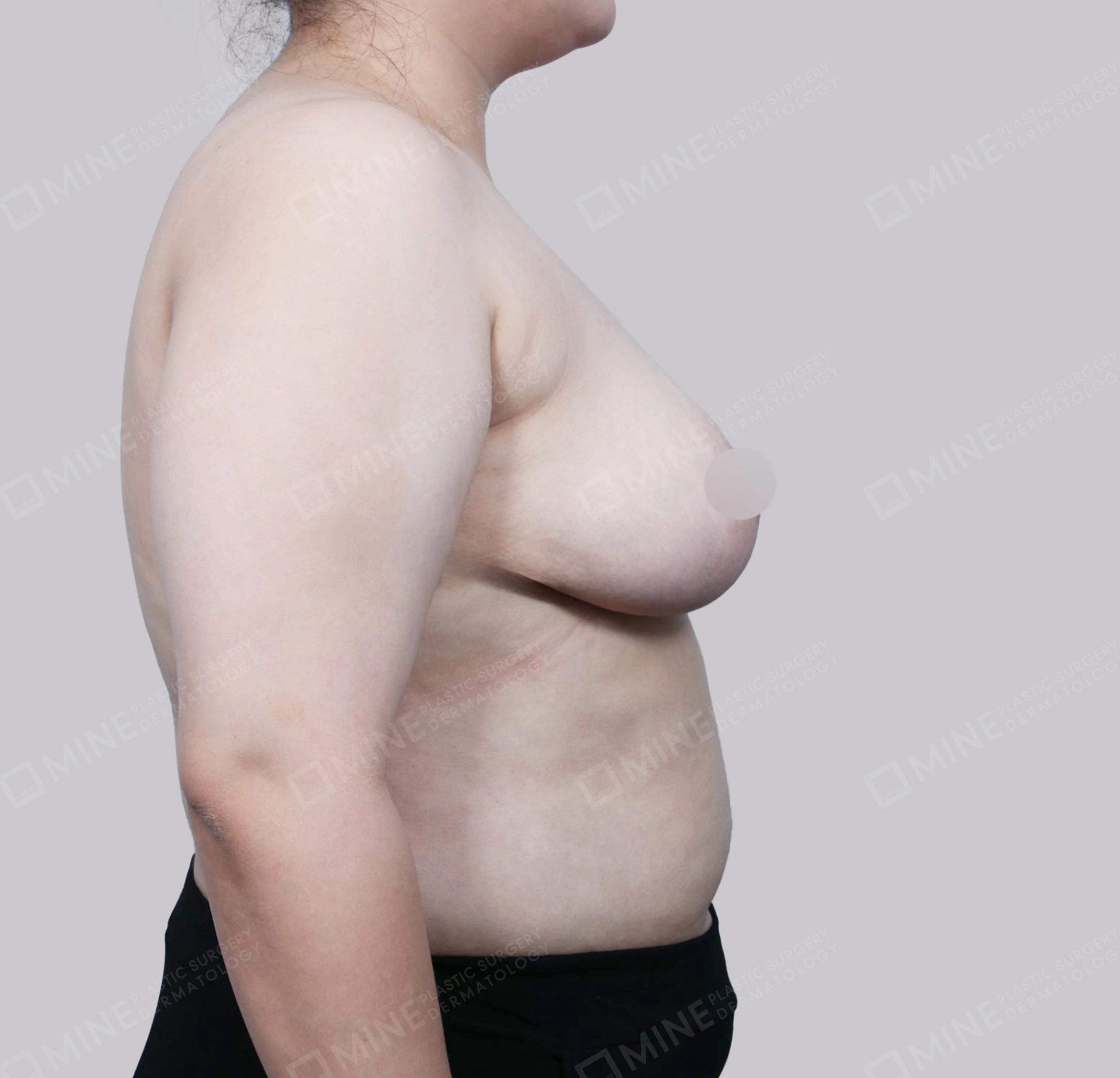 乳房縮小-側面-術後