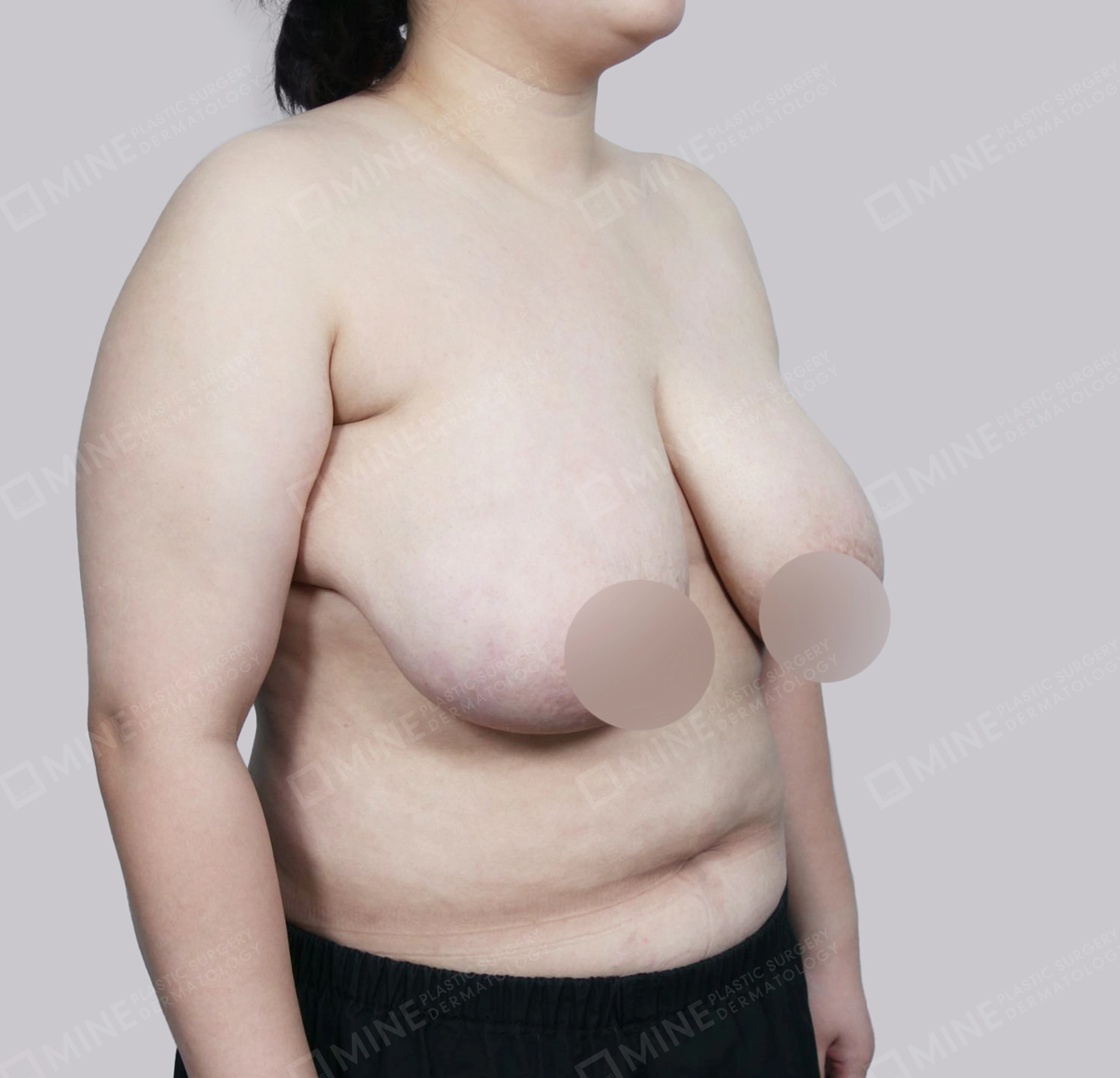 乳房縮小-45度-術前
