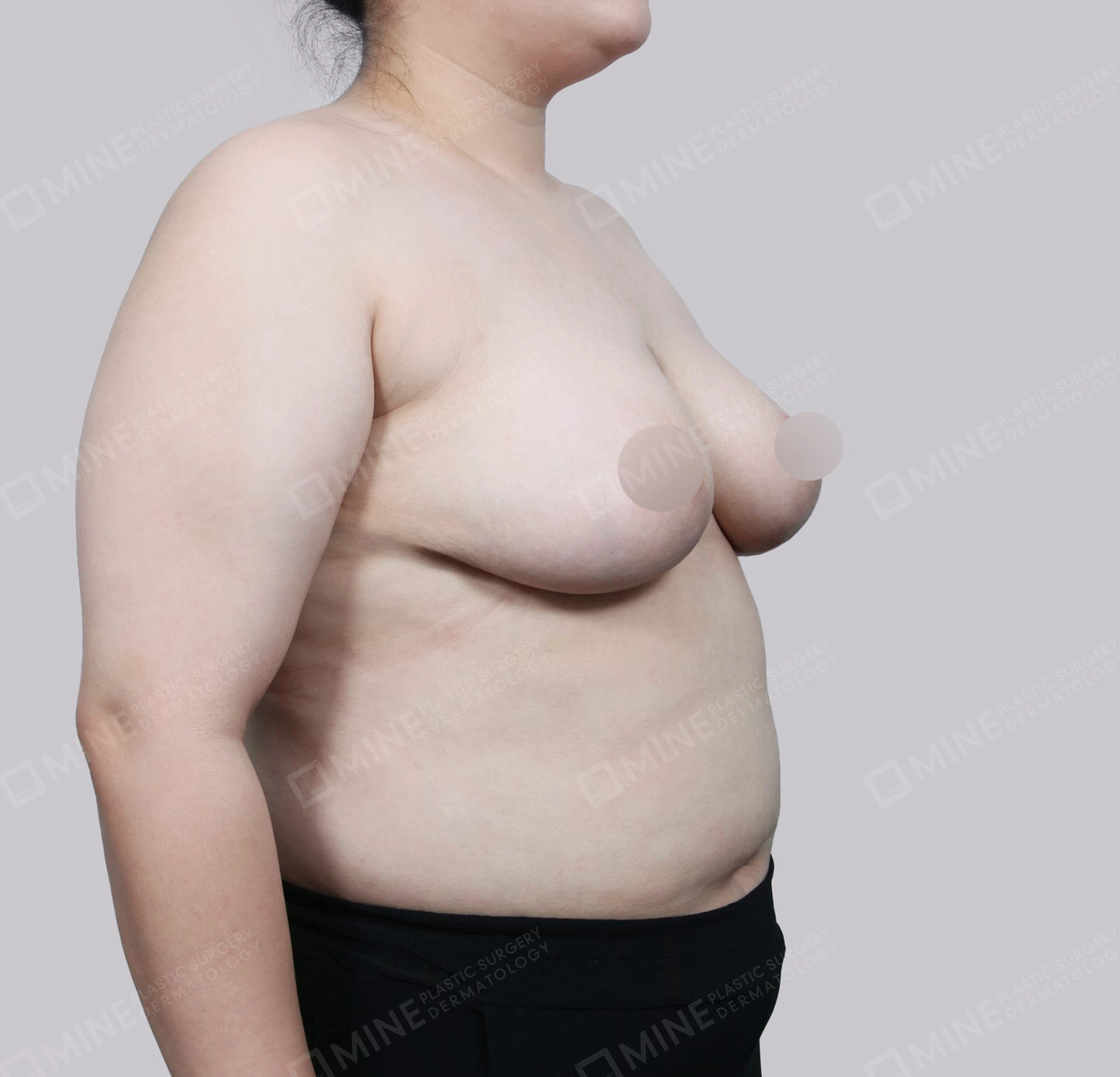 乳房縮小-45度-術後