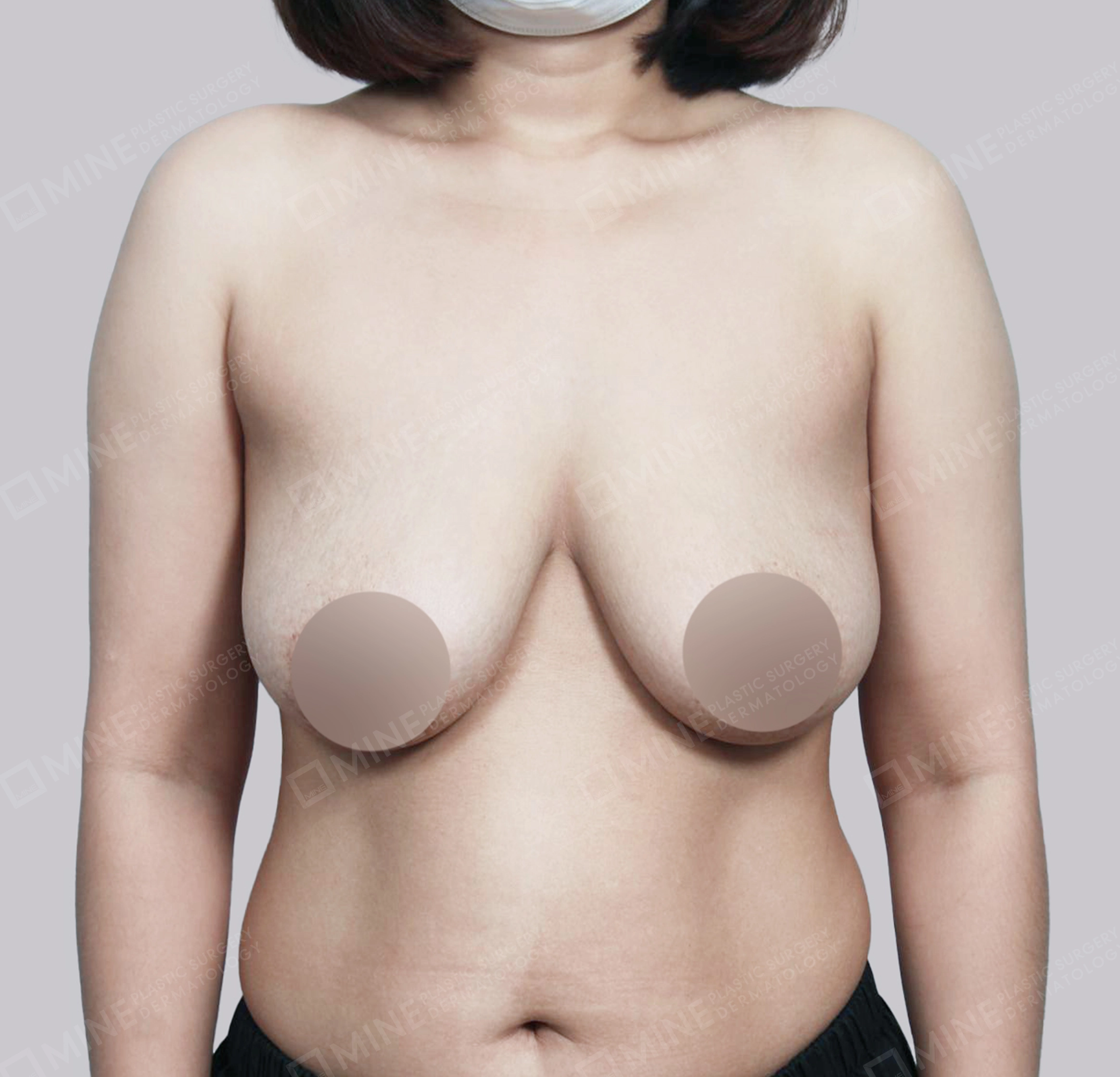 乳房縮小-正面-術前