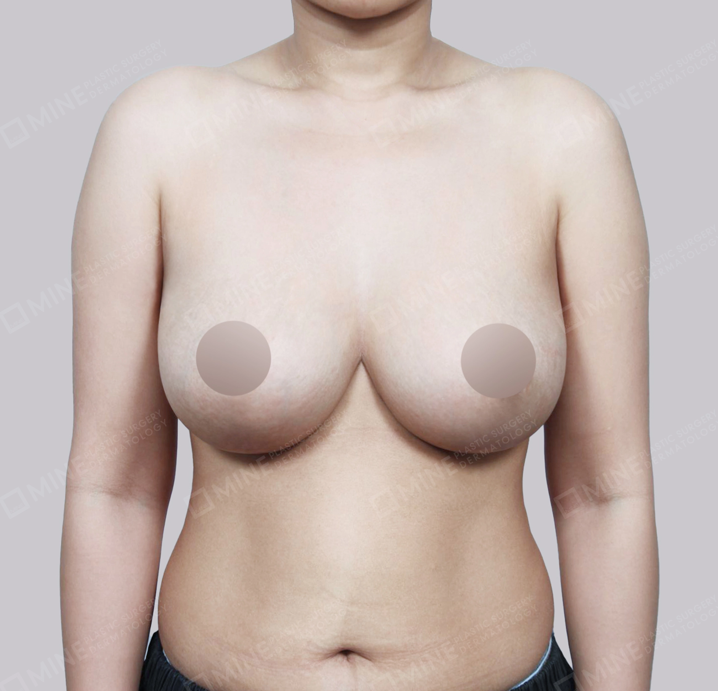 乳房縮小-正面-術後