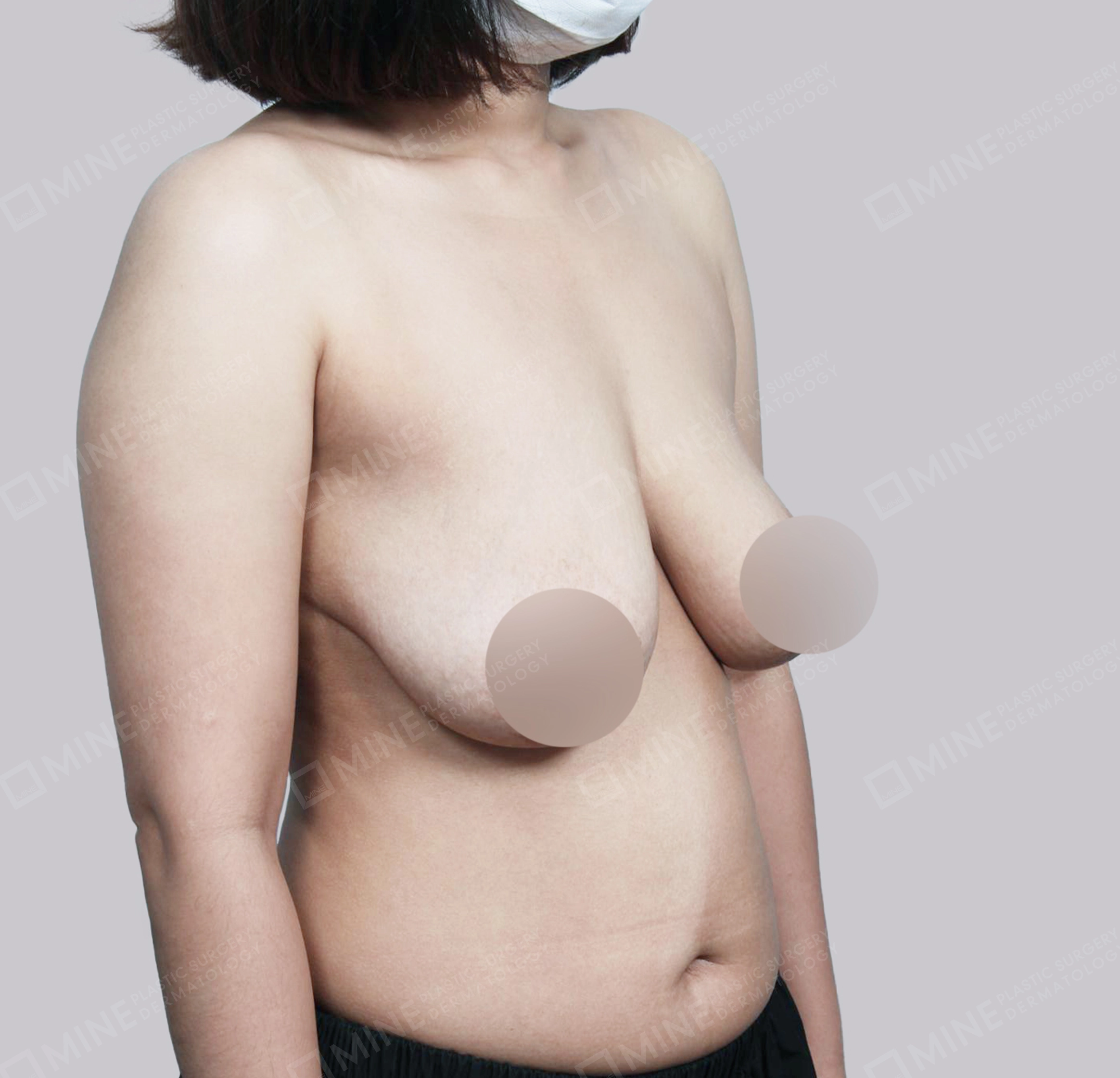 乳房縮小-側面-術前