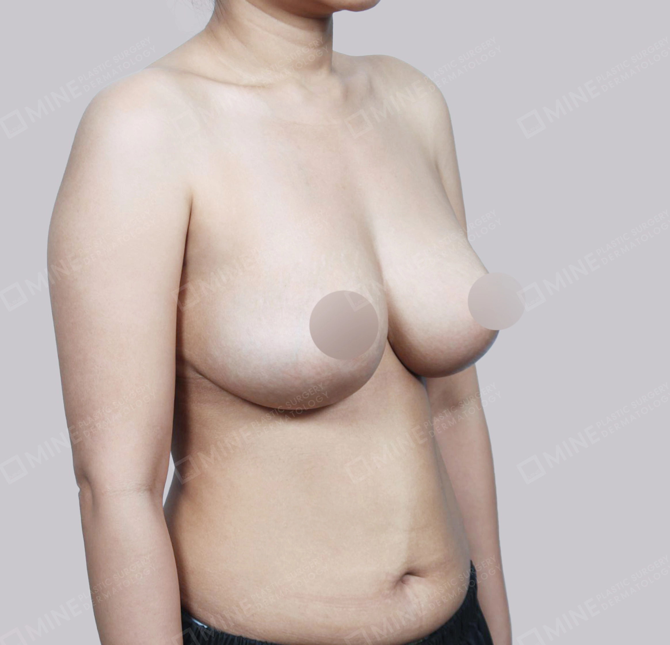 乳房縮小-側面-術後