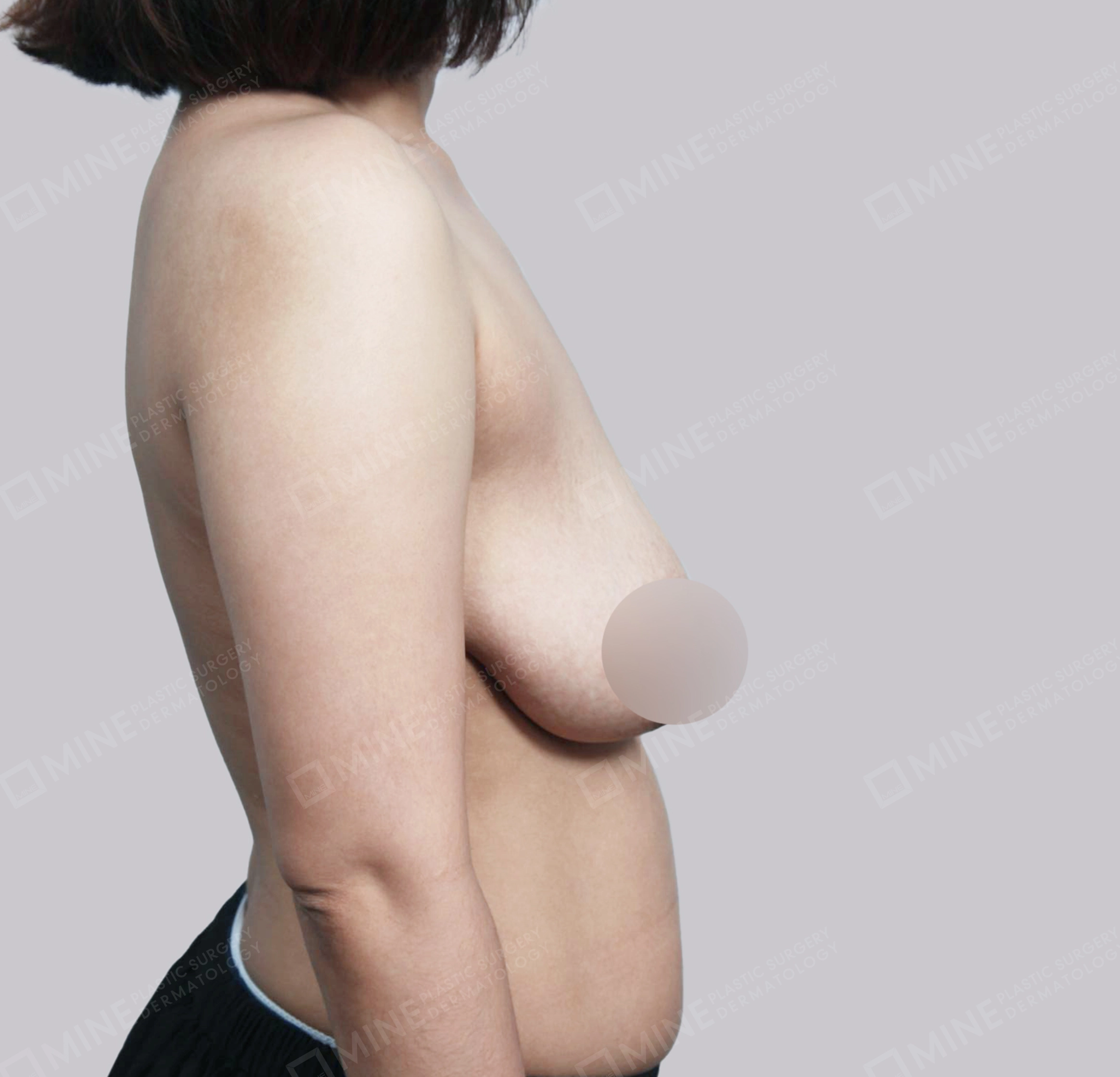 乳房縮小-45度-術前