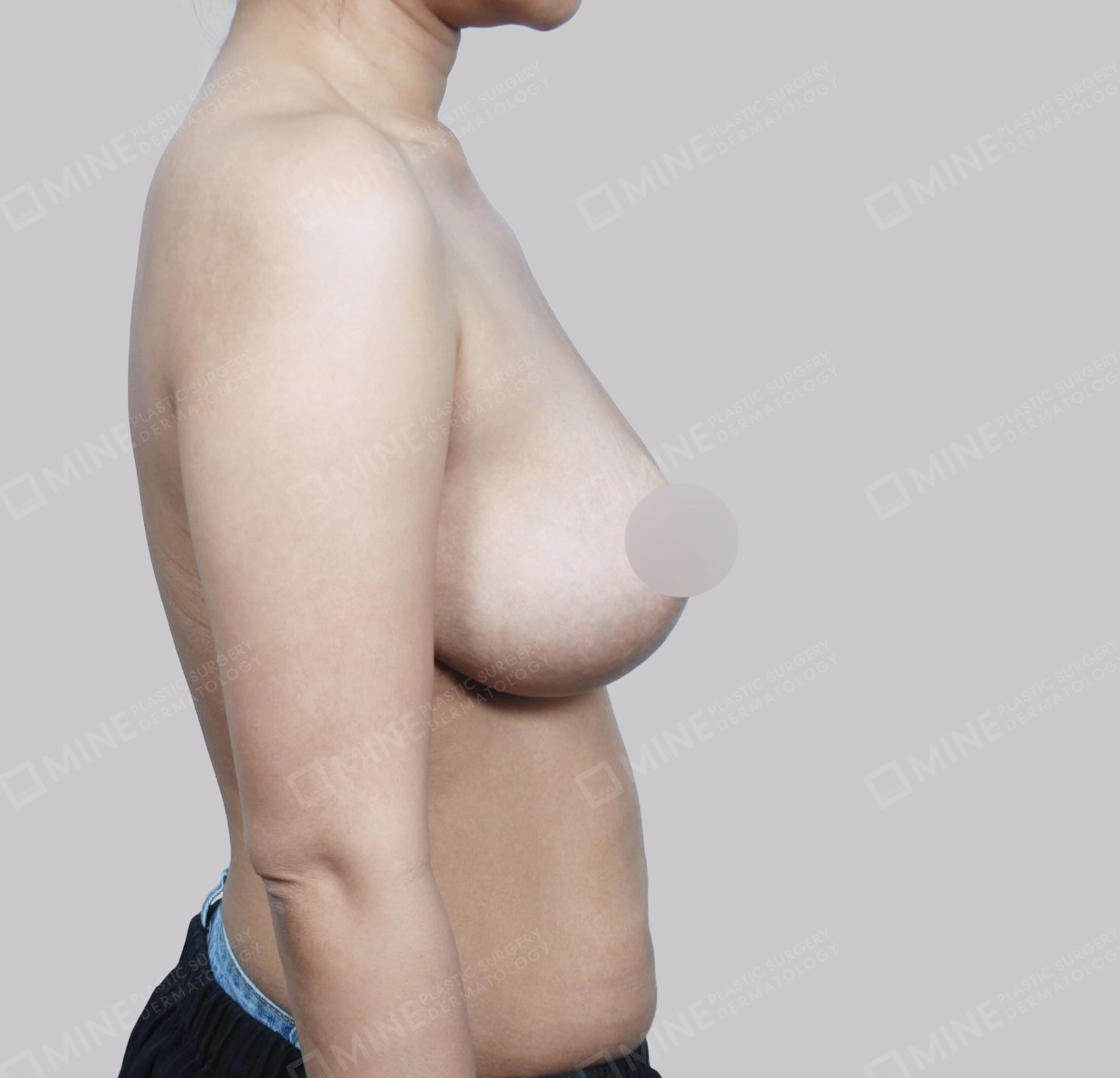 乳房縮小-45度-術後